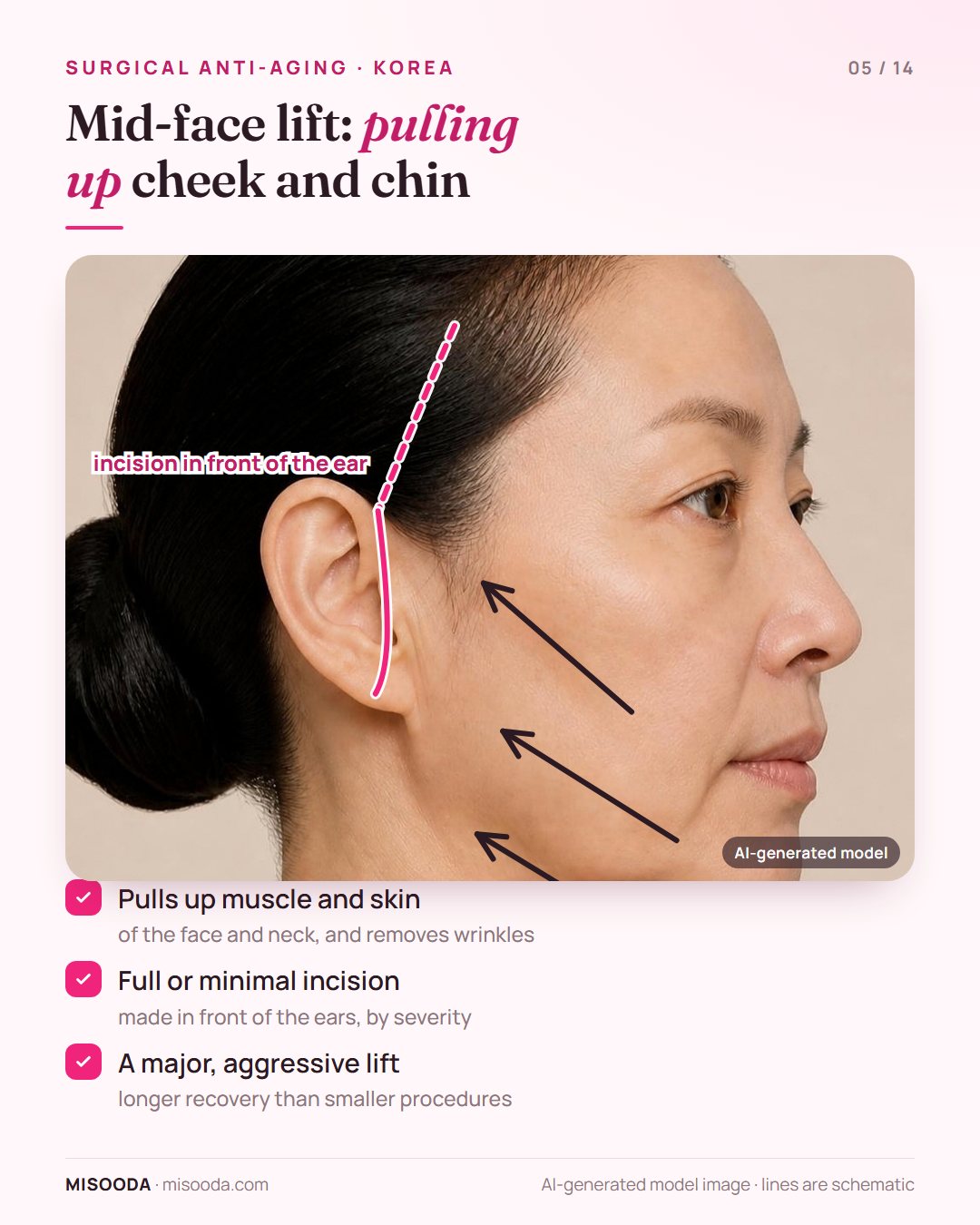 Mid-face lift incision in front of the ear with lift vectors pulling cheek, chin and neck muscle and skin upward — a major anti-aging surgery