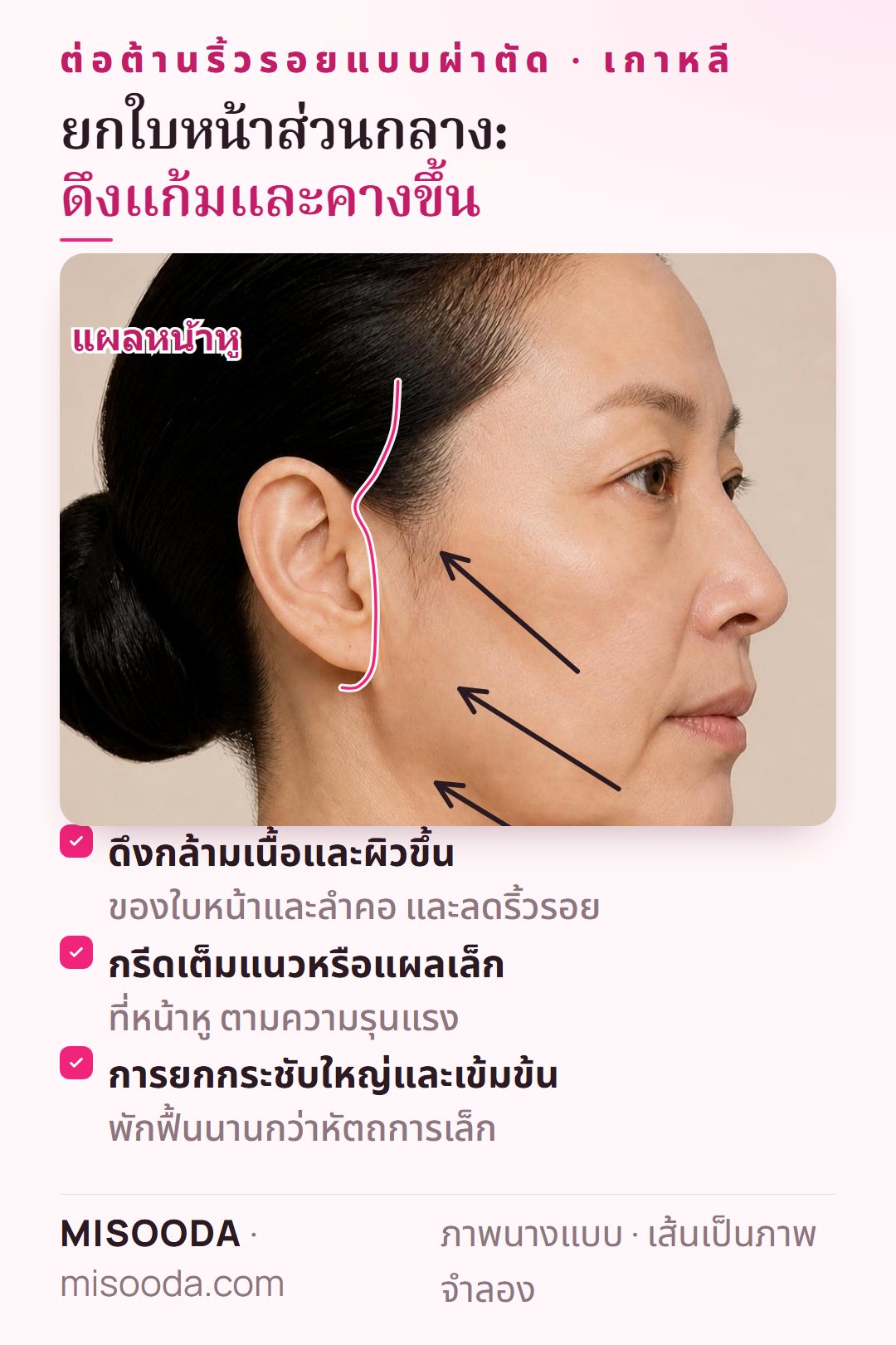 แผลยกใบหน้าส่วนกลาง เกาหลี ที่หน้าหู พร้อมทิศทางดึงกล้ามเนื้อและผิวแก้ม คาง และคอขึ้น — การผ่าตัดต่อต้านริ้วรอยครั้งใหญ่