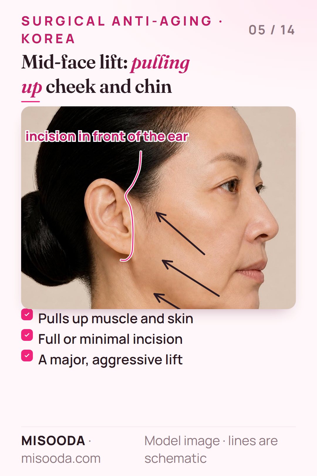 Mid-face lift incision in front of the ear with lift vectors pulling cheek, chin and neck muscle and skin upward — a major anti-aging surgery