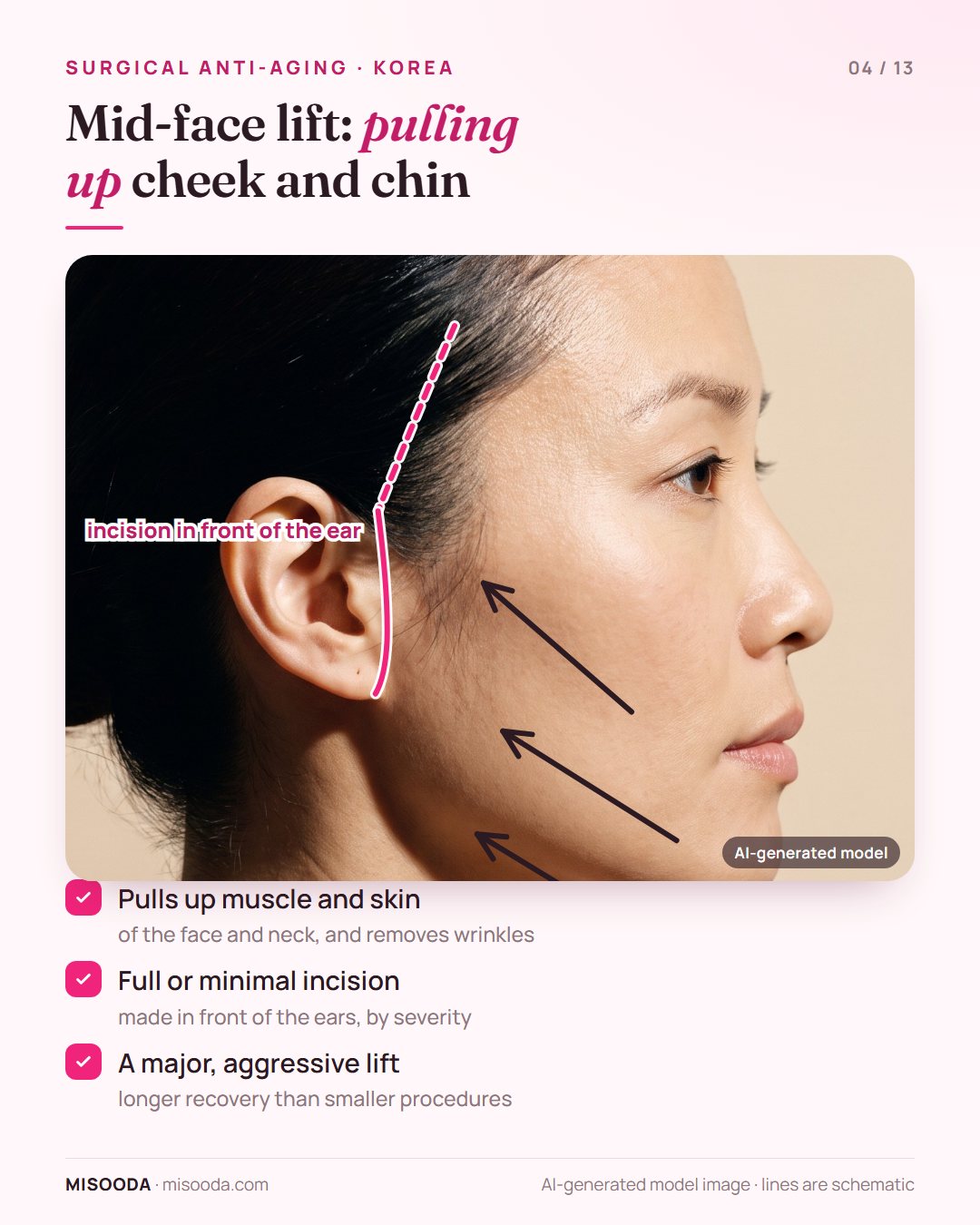 Mid-face lift incision in front of the ear with lift vectors pulling cheek, chin and neck muscle and skin upward — a major anti-aging surgery