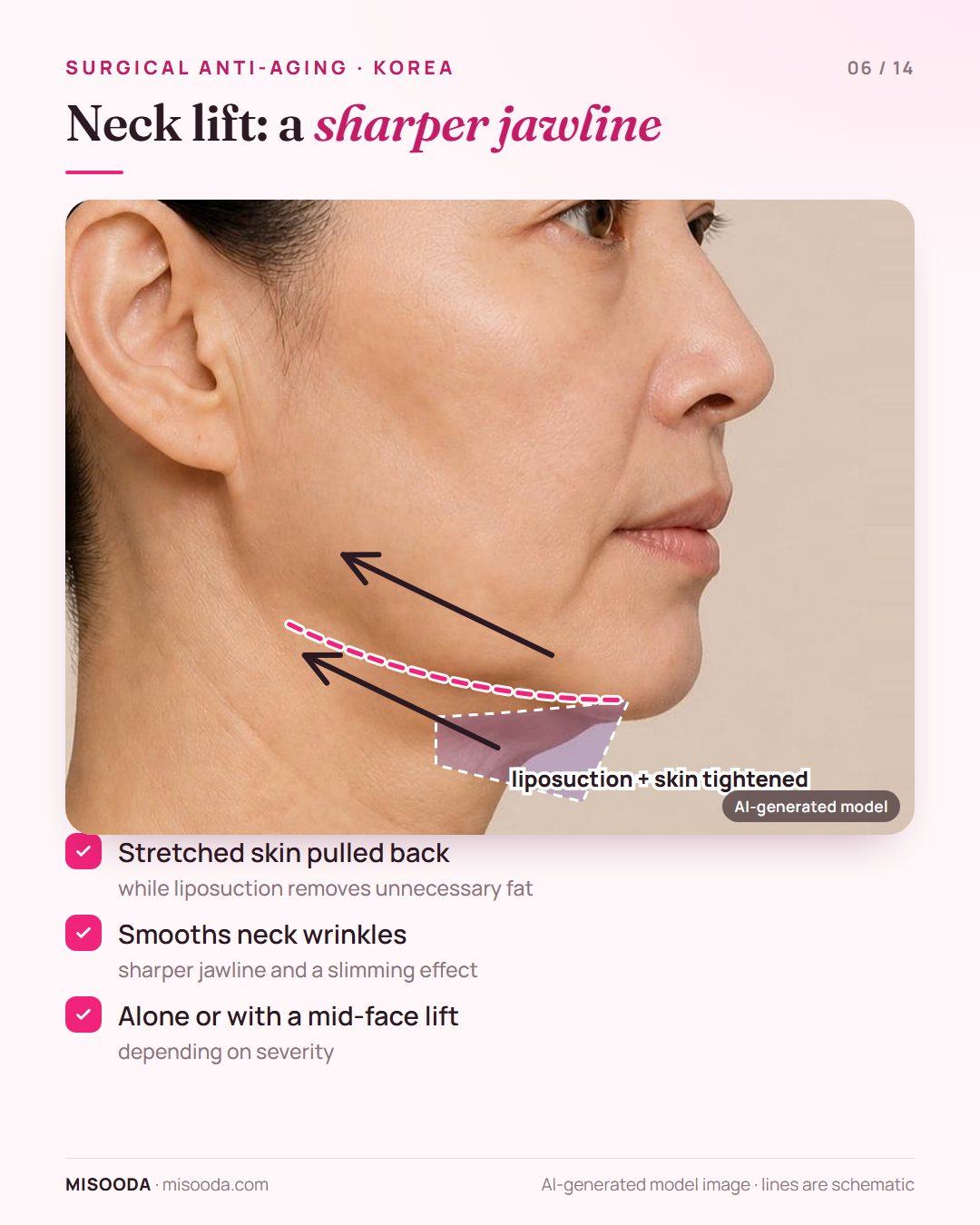 Neck lift in Korea: sagging skin under the chin and neck pulled back with liposuction to smooth neck wrinkles and define the jawline