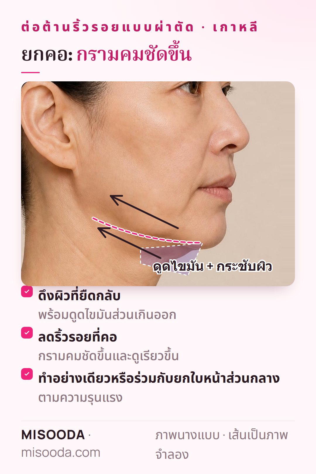 ยกคอ เกาหลี: ผิวหย่อนใต้คางและลำคอถูกดึงกลับพร้อมดูดไขมัน เพื่อลดริ้วรอยที่คอและทำให้กรามคมชัด