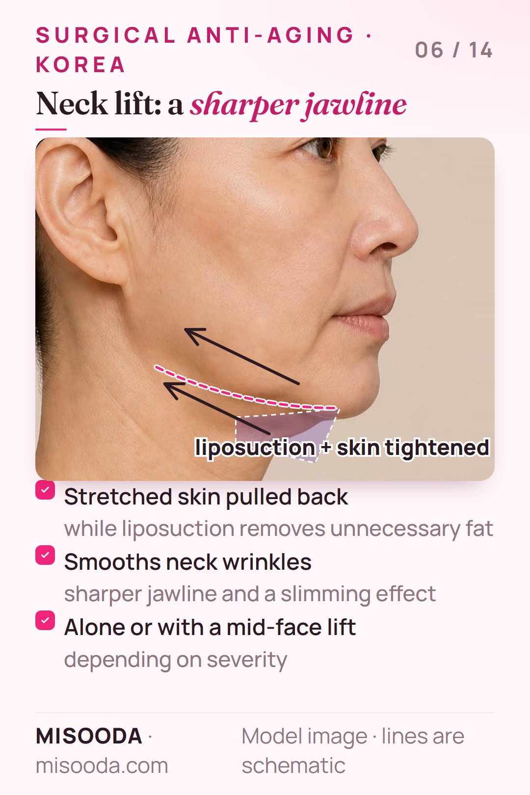 Neck lift in Korea: sagging skin under the chin and neck pulled back with liposuction to smooth neck wrinkles and define the jawline