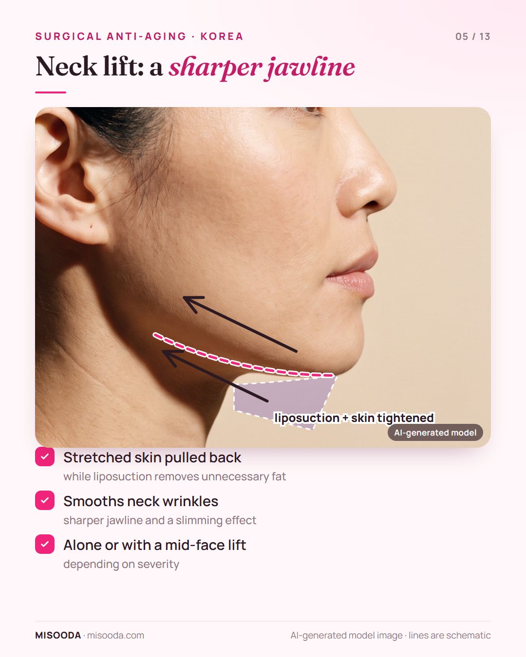 Neck lift in Korea: sagging skin under the chin and neck pulled back with liposuction to smooth neck wrinkles and define the jawline