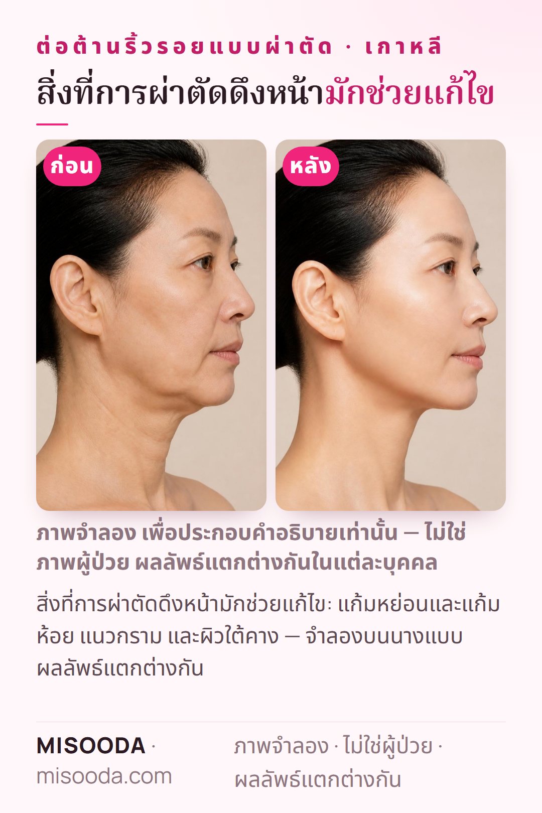 ภาพประกอบเป้าหมายทั่วไปของการผ่าตัดดึงหน้าที่เกาหลี — แก้ม แก้มห้อย แนวกราม และผิวใต้คาง — จำลองบนนางแบบ ไม่ใช่ผู้ป่วย