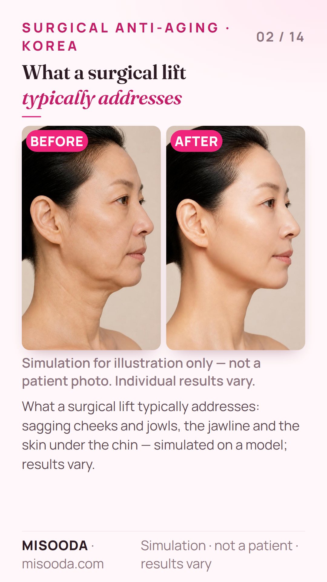 Illustration of the typical goals of a surgical face lift in Korea — cheeks, jowls, jawline and the skin under the chin — simulated on a model, not a patient