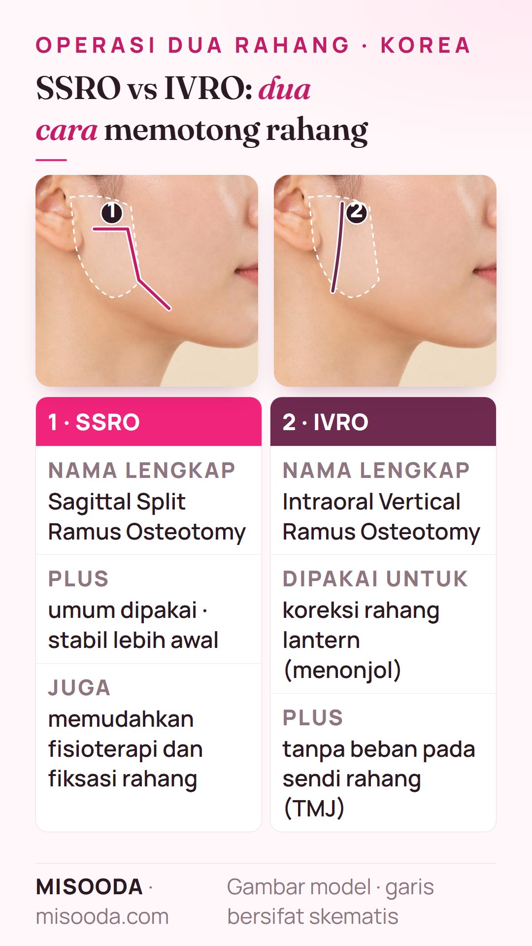 SSRO vs IVRO untuk operasi dua rahang: sagittal split ramus osteotomy untuk stabilitas awal dan intraoral vertical ramus osteotomy untuk rahang lantern tanpa beban TMJ