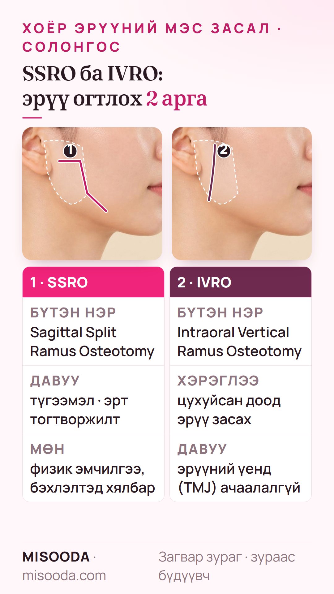 Хоёр эрүүний мэс засалд SSRO ба IVRO: эрт тогтворжилттой sagittal split ramus osteotomy, эрүүний үенд ачаалалгүй цухуйсан доод эрүү засах intraoral vertical ramus osteotomy