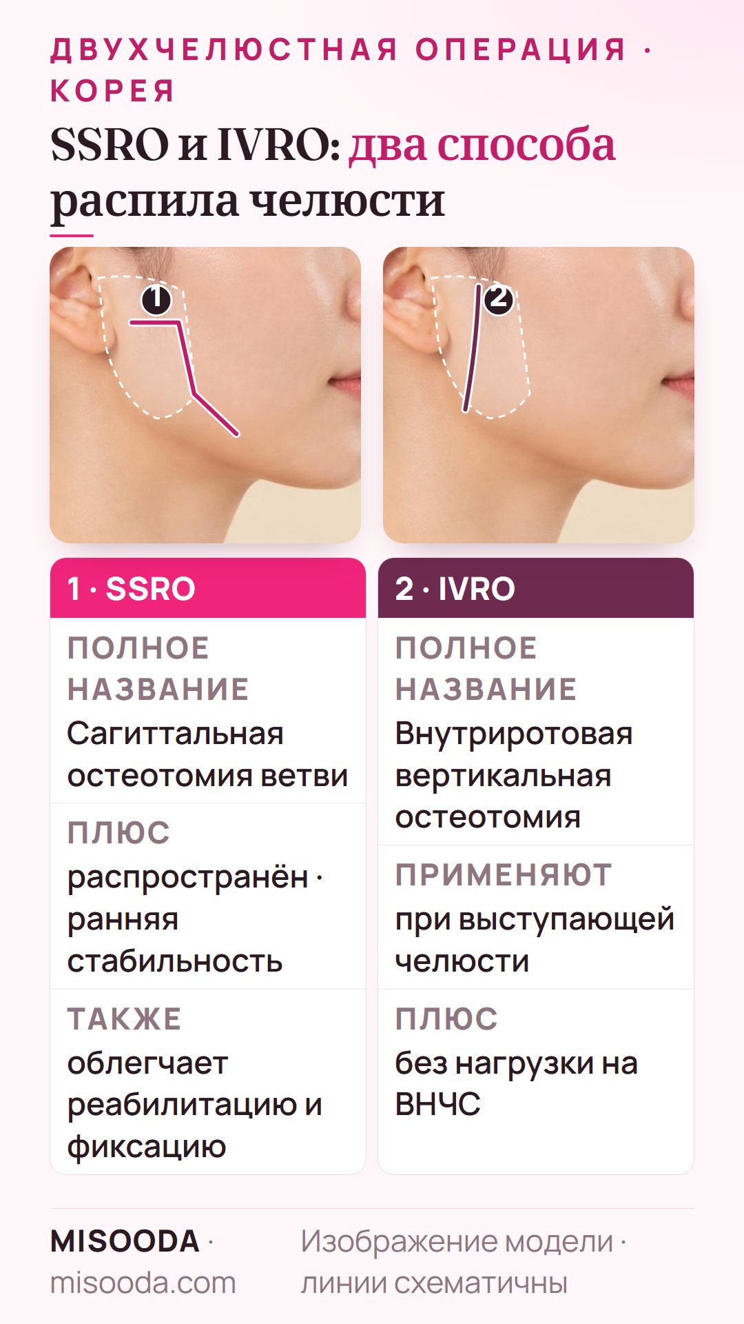 SSRO и IVRO при двухчелюстной операции: сагиттальная остеотомия ветви для ранней стабильности и внутриротовая вертикальная остеотомия при выступающей челюсти без нагрузки на ВНЧС