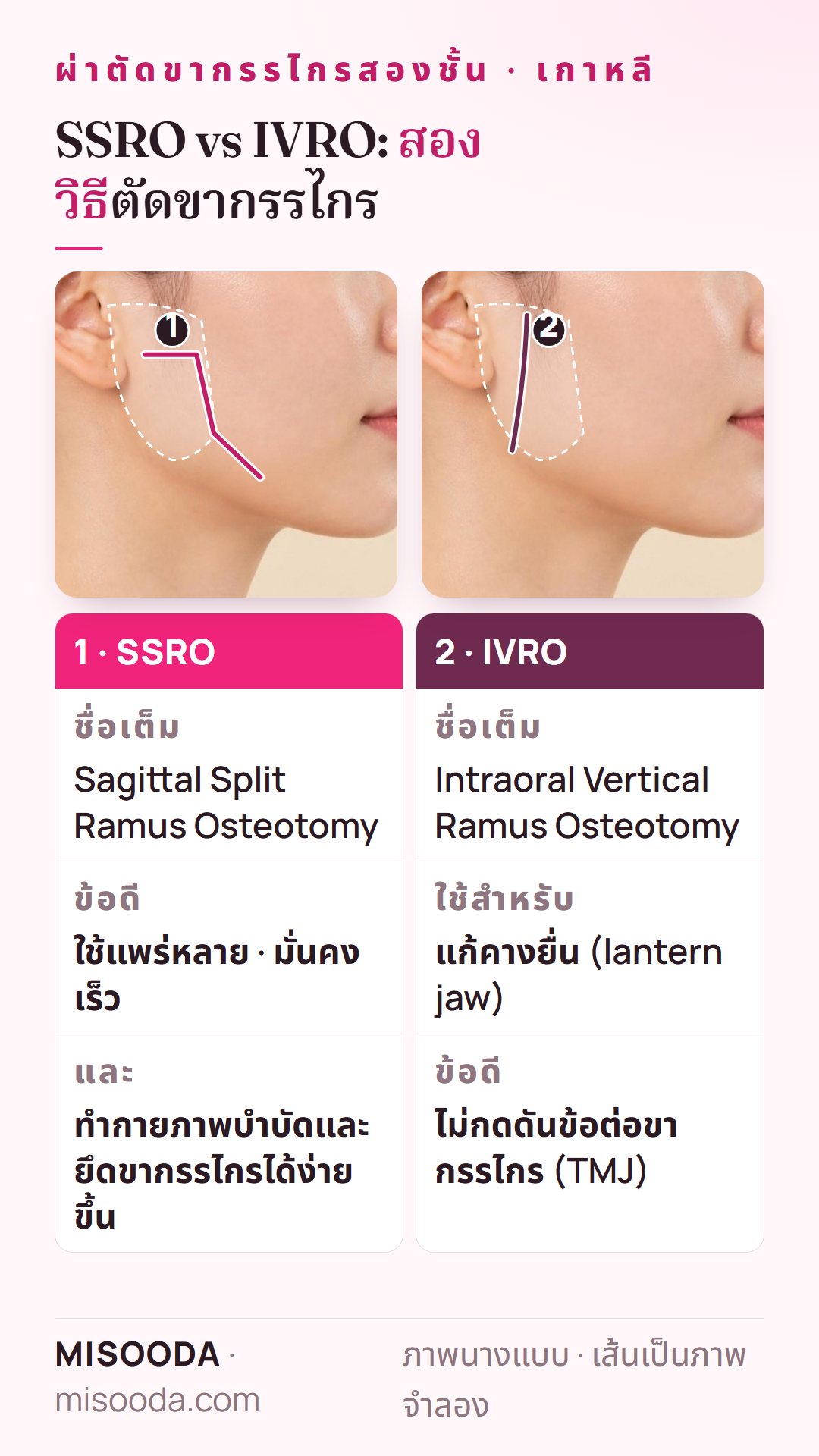 SSRO vs IVRO สำหรับผ่าตัดขากรรไกรสองชั้น เกาหลี: sagittal split ramus osteotomy มั่นคงเร็ว และ intraoral vertical ramus osteotomy แก้คางยื่นโดยไม่กดดัน TMJ