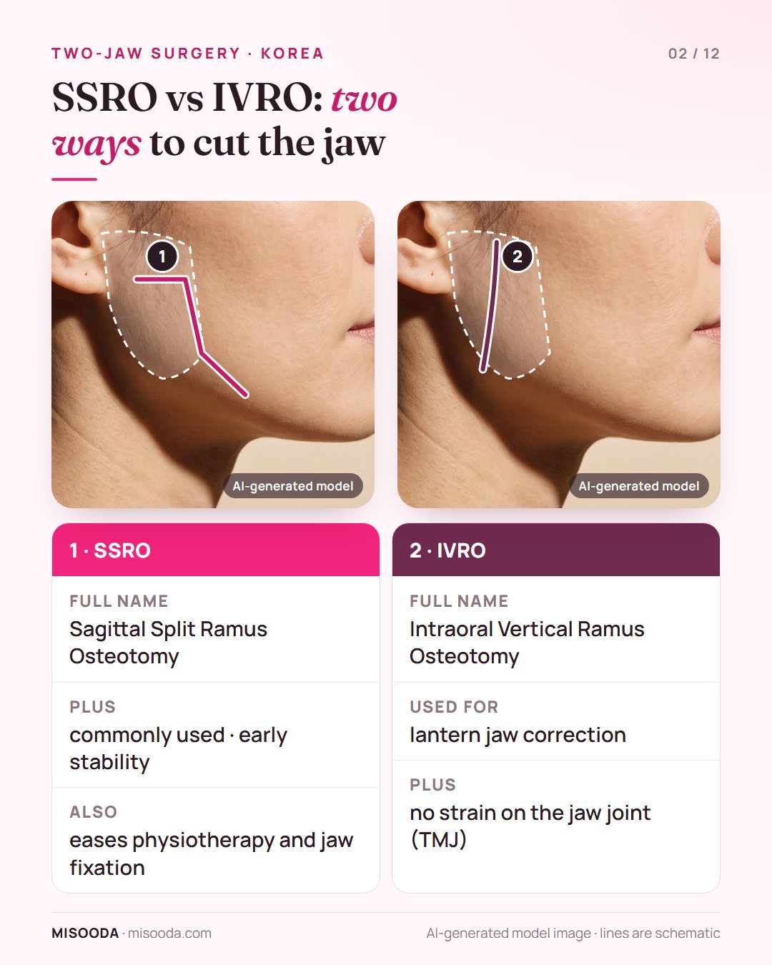 SSRO vs IVRO for two-jaw surgery: sagittal split ramus osteotomy for early stability and intraoral vertical ramus osteotomy for lantern jaw without TMJ strain