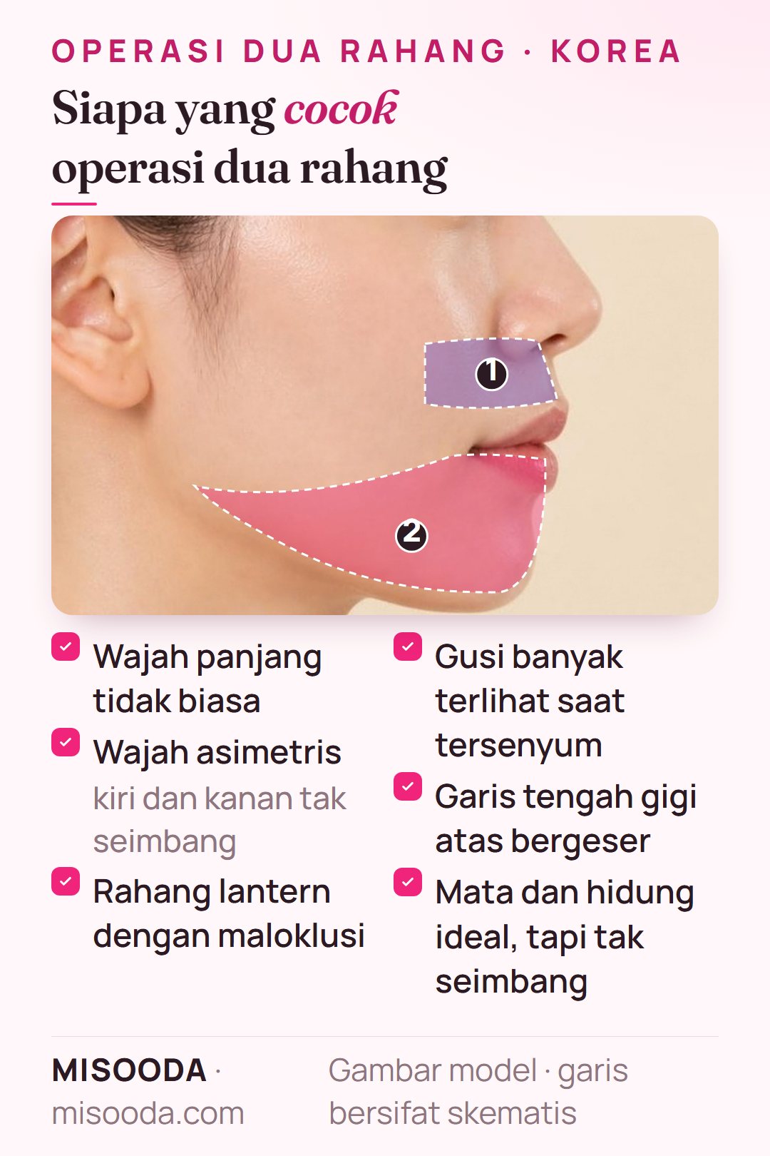 Kandidat operasi dua rahang di Korea: wajah panjang, wajah asimetris, rahang lantern dengan maloklusi, gummy smile, gigi atas tak di tengah, fitur tak seimbang