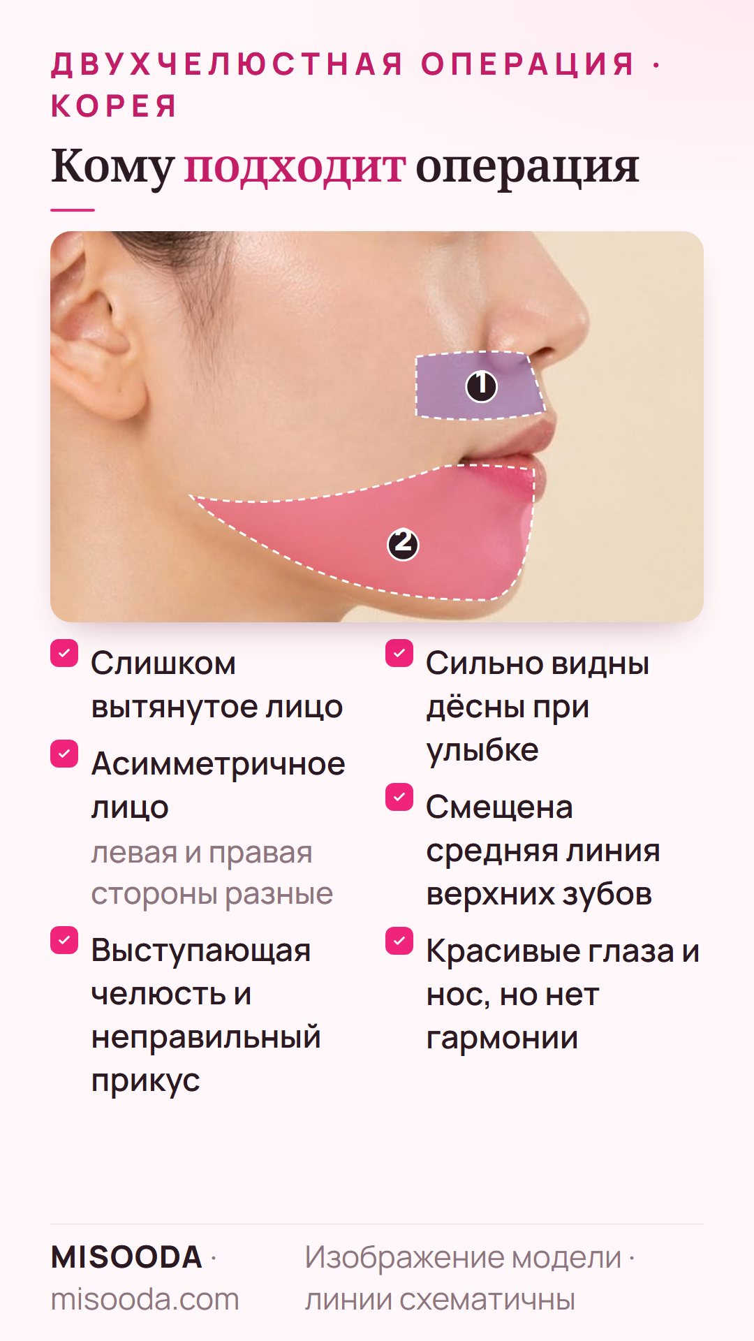 Кому подходит двухчелюстная операция: вытянутое или асимметричное лицо, выступающая челюсть с неправильным прикусом, «десневая» улыбка, смещённые верхние зубы