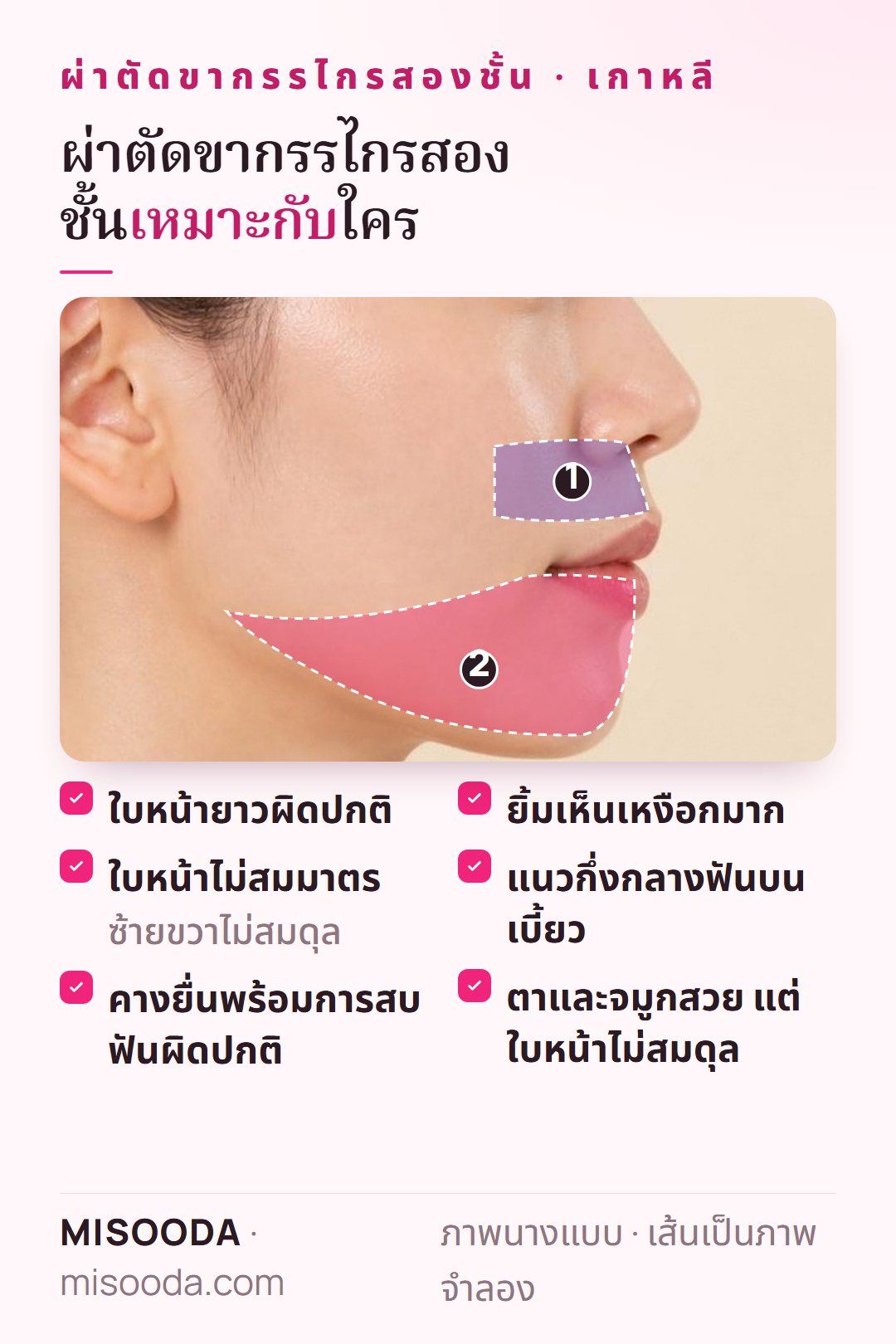 ผู้ที่เหมาะกับผ่าตัดขากรรไกรสองชั้น เกาหลี: ใบหน้ายาว ใบหน้าไม่สมมาตร คางยื่นพร้อมสบฟันผิด ยิ้มเห็นเหงือก แนวฟันบนเบี้ยว ใบหน้าไม่สมดุล