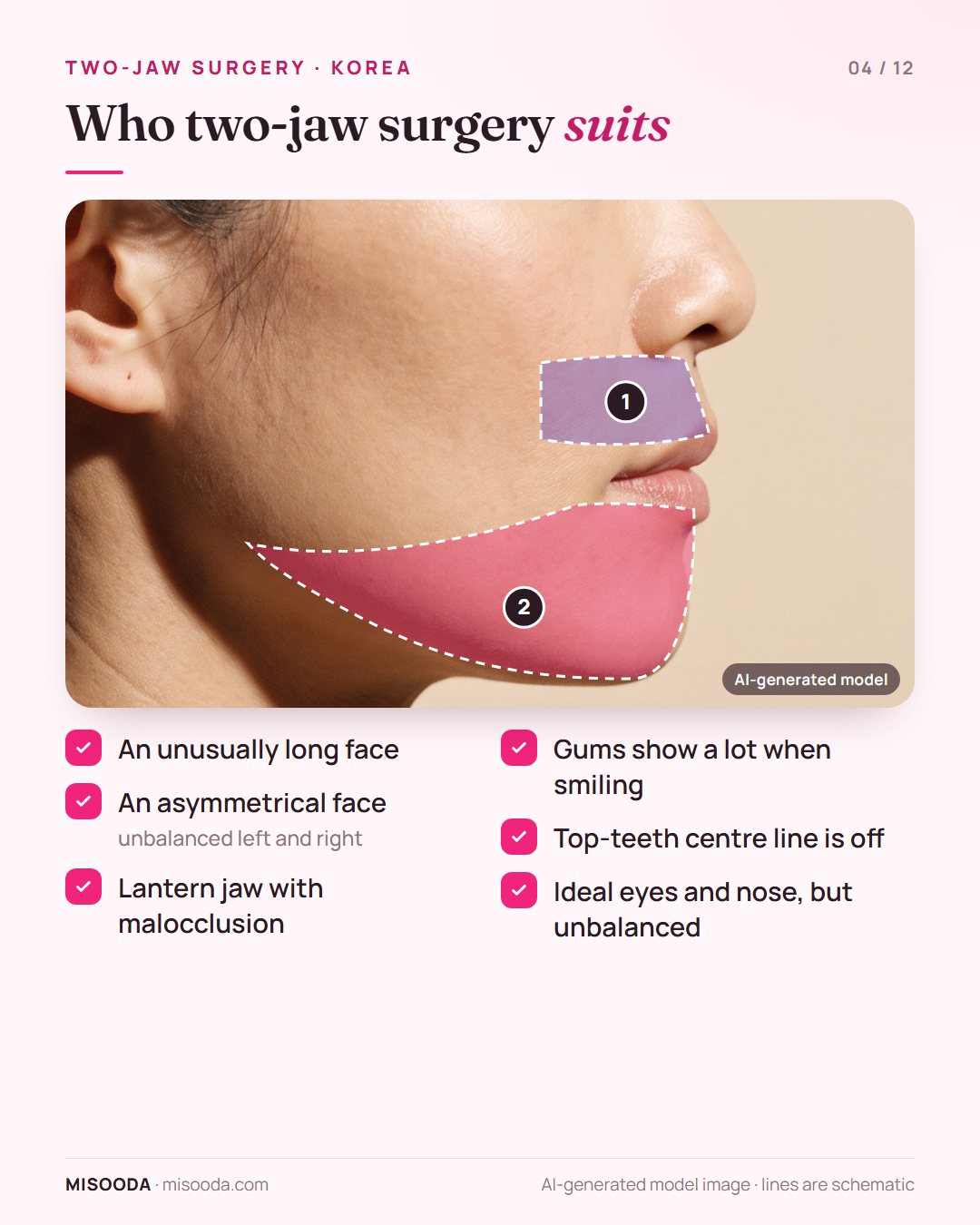 Candidates for two-jaw surgery: long face, asymmetrical face, lantern jaw with malocclusion, gummy smile, off-centre top teeth, unbalanced features