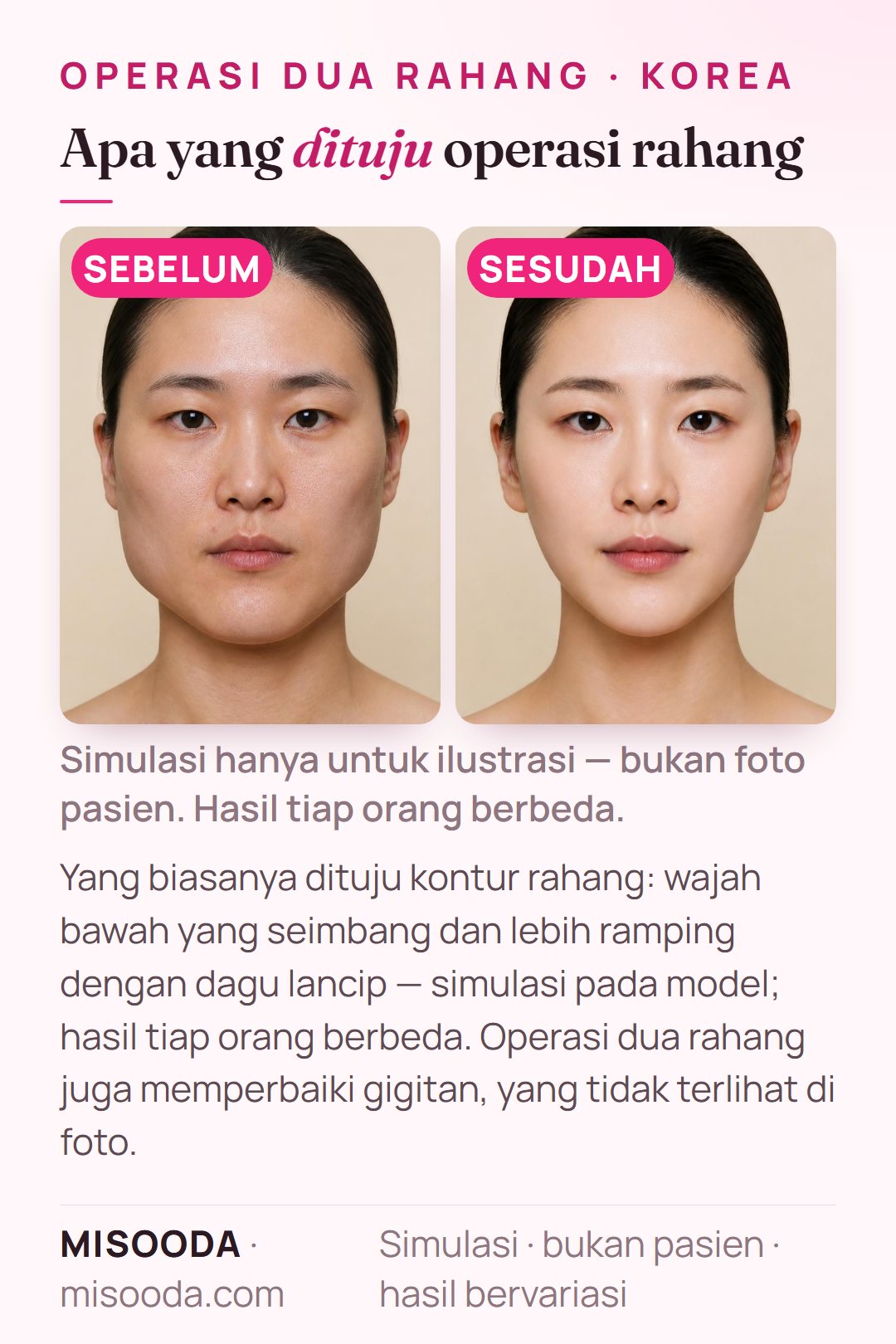 Ilustrasi tujuan umum kontur rahang di Korea — wajah bawah yang seimbang dan lebih ramping dengan dagu lancip — disimulasikan pada model; koreksi gigitan tidak terlihat di foto