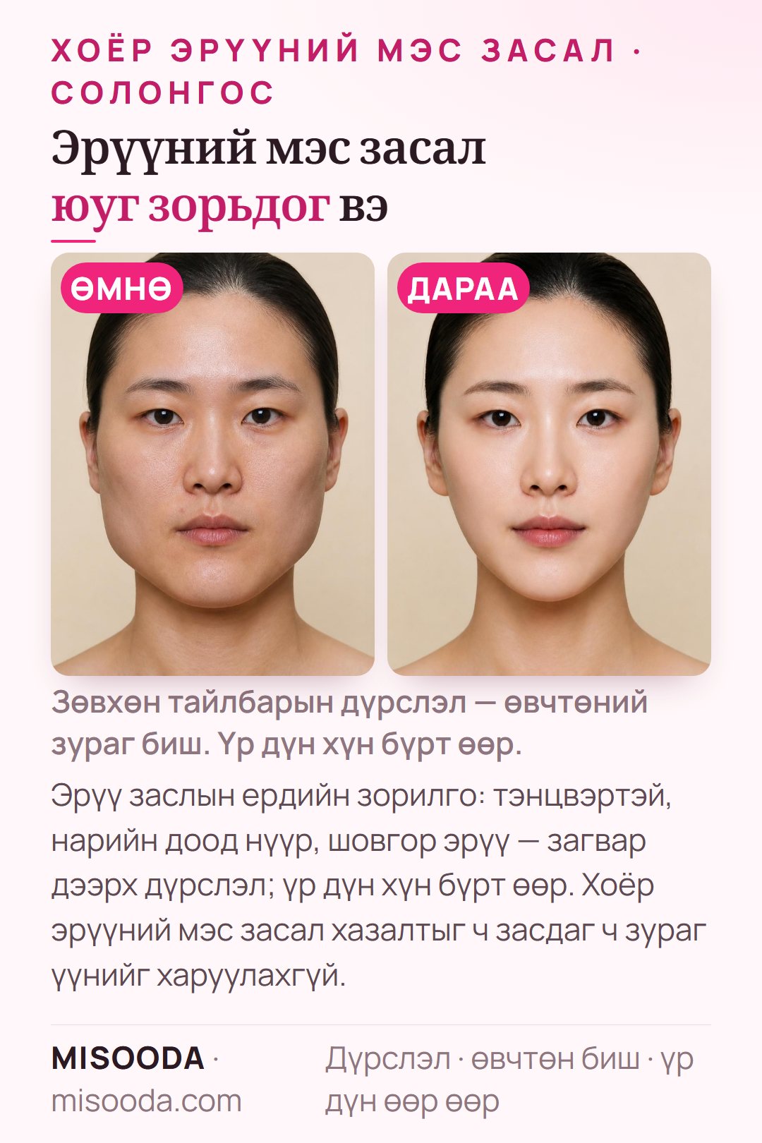 Солонгост эрүү заслын ердийн зорилго — тэнцвэртэй, нарийн доод нүүр, шовгор эрүү — загвар дээрх дүрслэл; хазалт засалт зурагт харагдахгүй