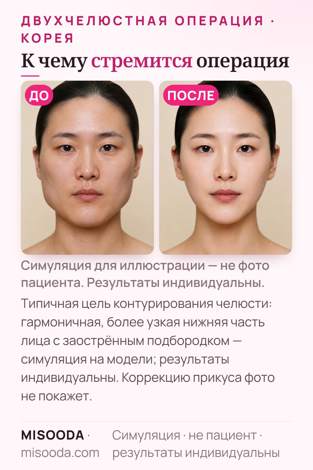 Иллюстрация типичных целей контурирования челюсти в Корее — гармоничная, более узкая нижняя часть лица с заострённым подбородком — симуляция на модели; коррекцию прикуса на фото не видно