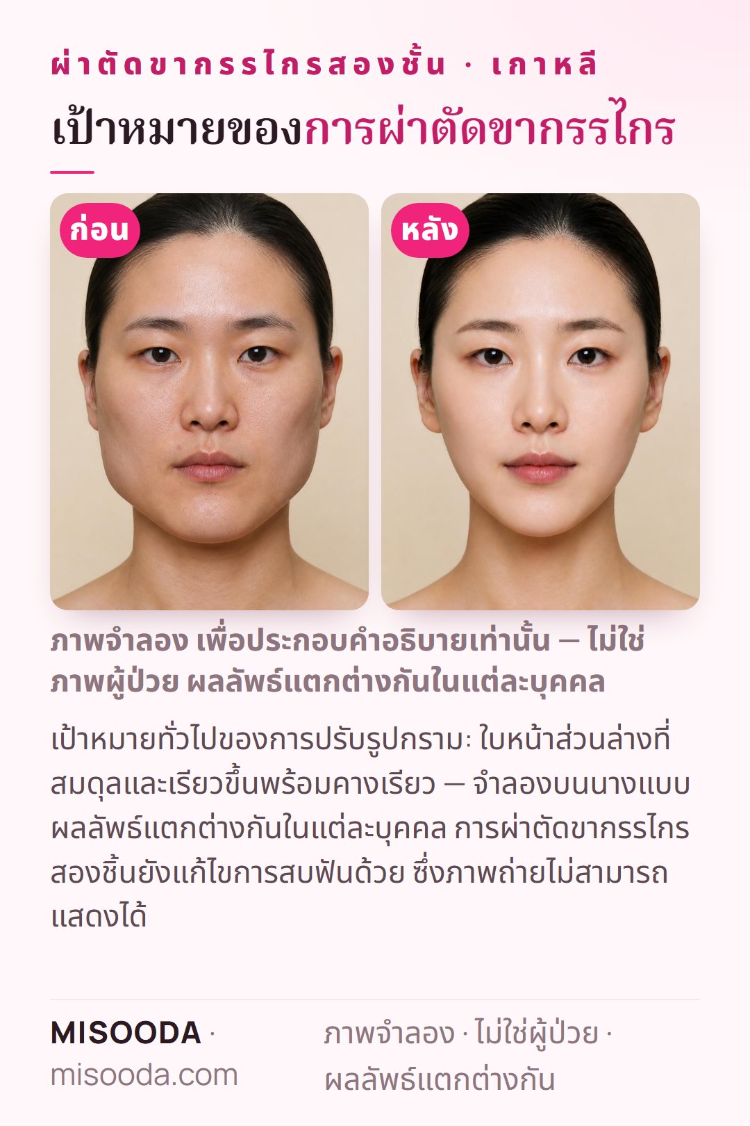 ภาพประกอบเป้าหมายทั่วไปของการปรับรูปกรามที่เกาหลี — ใบหน้าส่วนล่างที่สมดุลและเรียวขึ้นพร้อมคางเรียว — จำลองบนนางแบบ การแก้ไขการสบฟันไม่สามารถเห็นได้ในภาพถ่าย