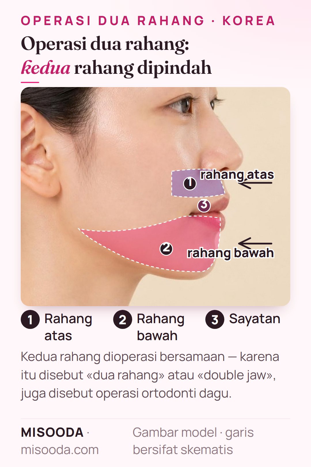 Operasi dua rahang (double jaw) di Korea: rahang atas dan bawah dipotong dan diposisikan ulang lewat sayatan di dalam mulut, ditampilkan pada profil samping