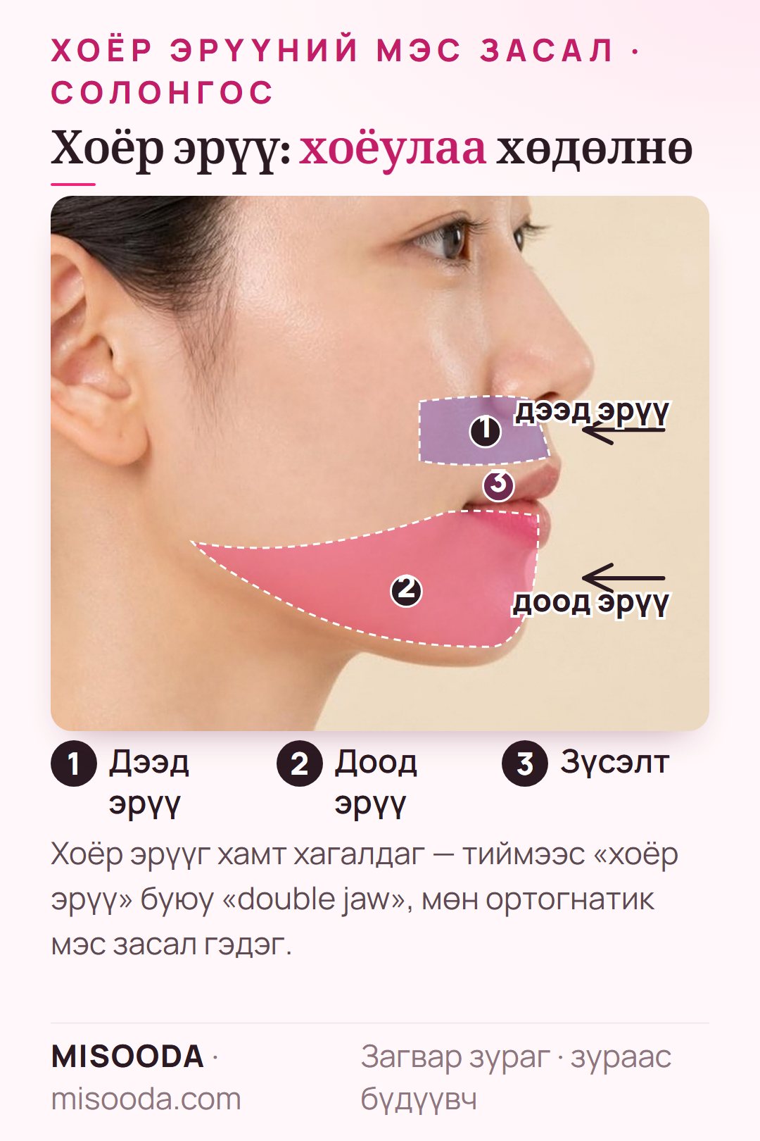 Солонгост хоёр эрүүний (double jaw) мэс засал: амны доторх зүсэлтээр дээд, доод эрүүг огтолж байрлалыг засах нь, хажуу төрхөөр
