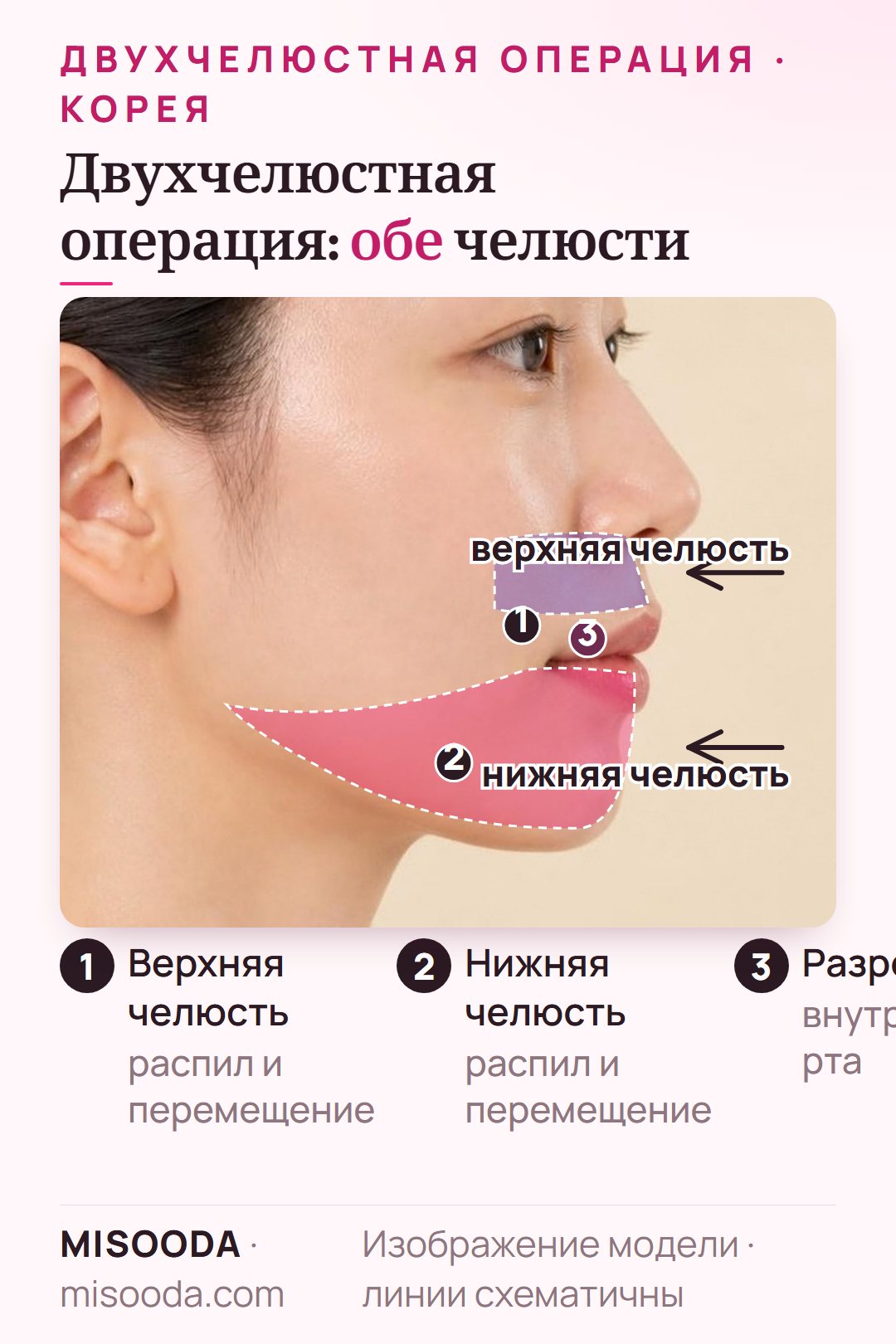 Двухчелюстная (бимаксиллярная) операция в Корее: верхнюю и нижнюю челюсть распиливают и перемещают через разрез внутри рта, вид в профиль