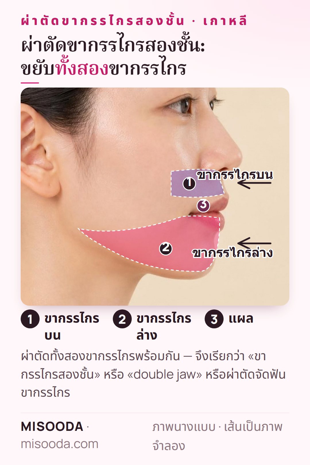 ผ่าตัดขากรรไกรสองชั้น เกาหลี (double jaw): ตัดและจัดตำแหน่งขากรรไกรบนและล่างใหม่ผ่านแผลในช่องปาก แสดงในมุมด้านข้าง