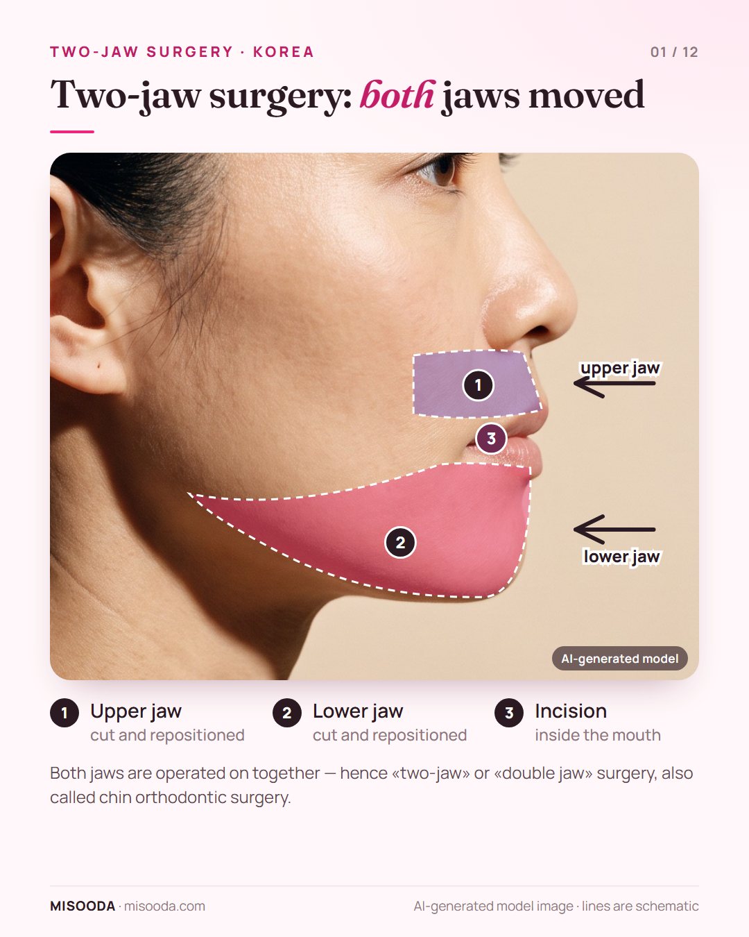 Two-jaw (double jaw) surgery in Korea: upper and lower jaw cut and repositioned through an incision inside the mouth, shown on a side profile