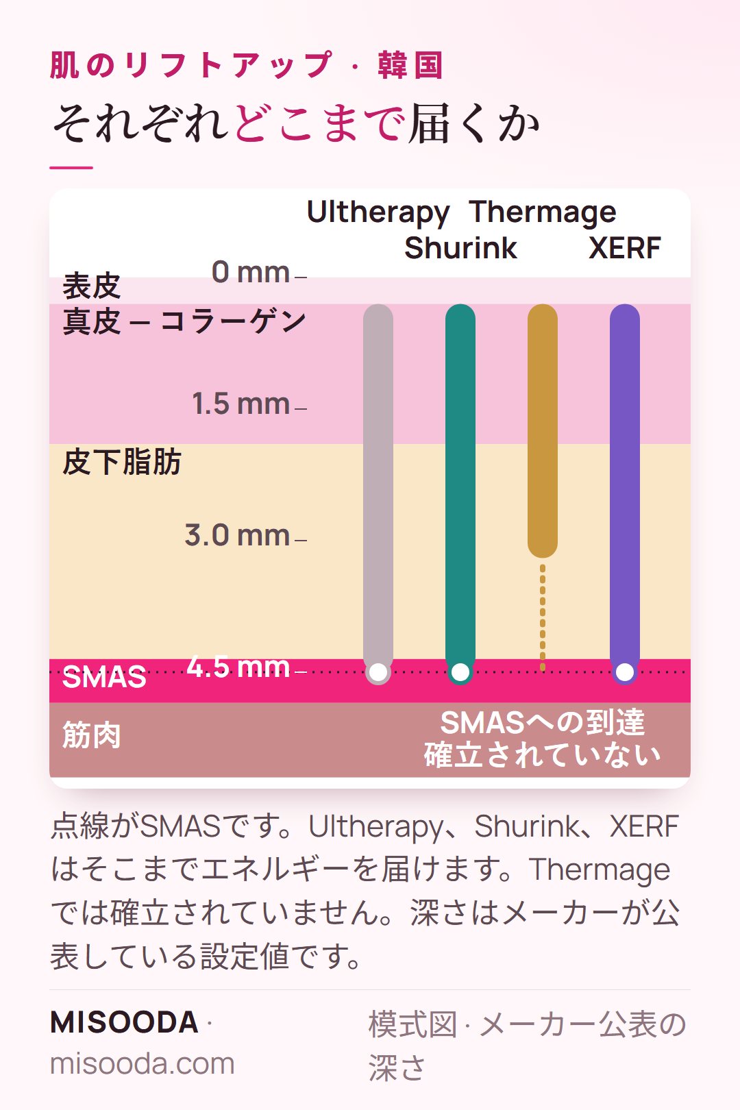 韓国 リフトアップ機器の深さの図:Ultherapy、Shurink、XERFは約4.5 mmのSMASに届き、Thermageは真皮と脂肪を加熱、SMASへの到達は確立されていない