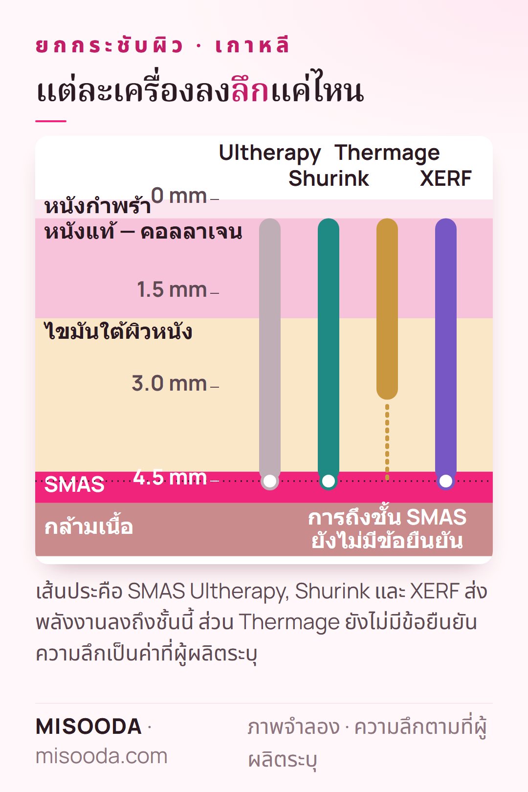 ภาพความลึกการรักษา ยกกระชับผิว เกาหลี: Ultherapy, Shurink และ XERF ถึงชั้น SMAS ที่ราว 4.5 mm ส่วน Thermage ให้ความร้อนที่หนังแท้และไขมัน ยังไม่ยืนยันว่าถึง SMAS
