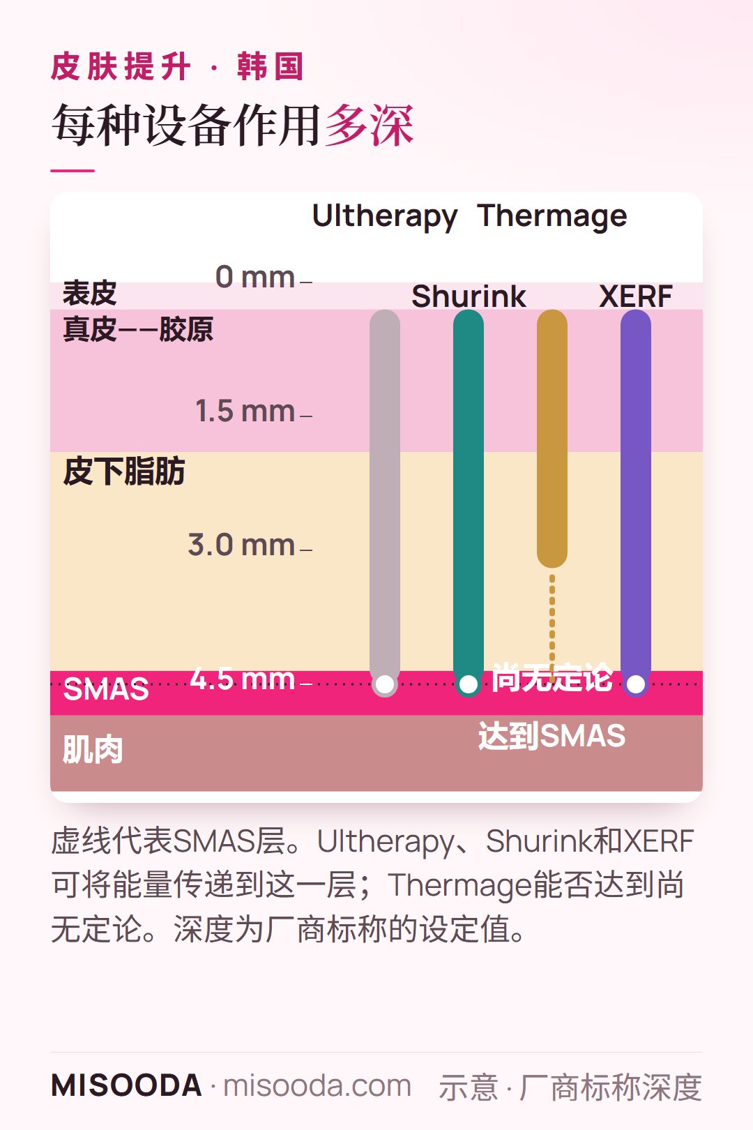 韩国提升设备治疗深度图:Ultherapy、Shurink 和 XERF 可达约4.5 mm的SMAS层;Thermage 加热真皮和脂肪,能否达到SMAS尚无定论