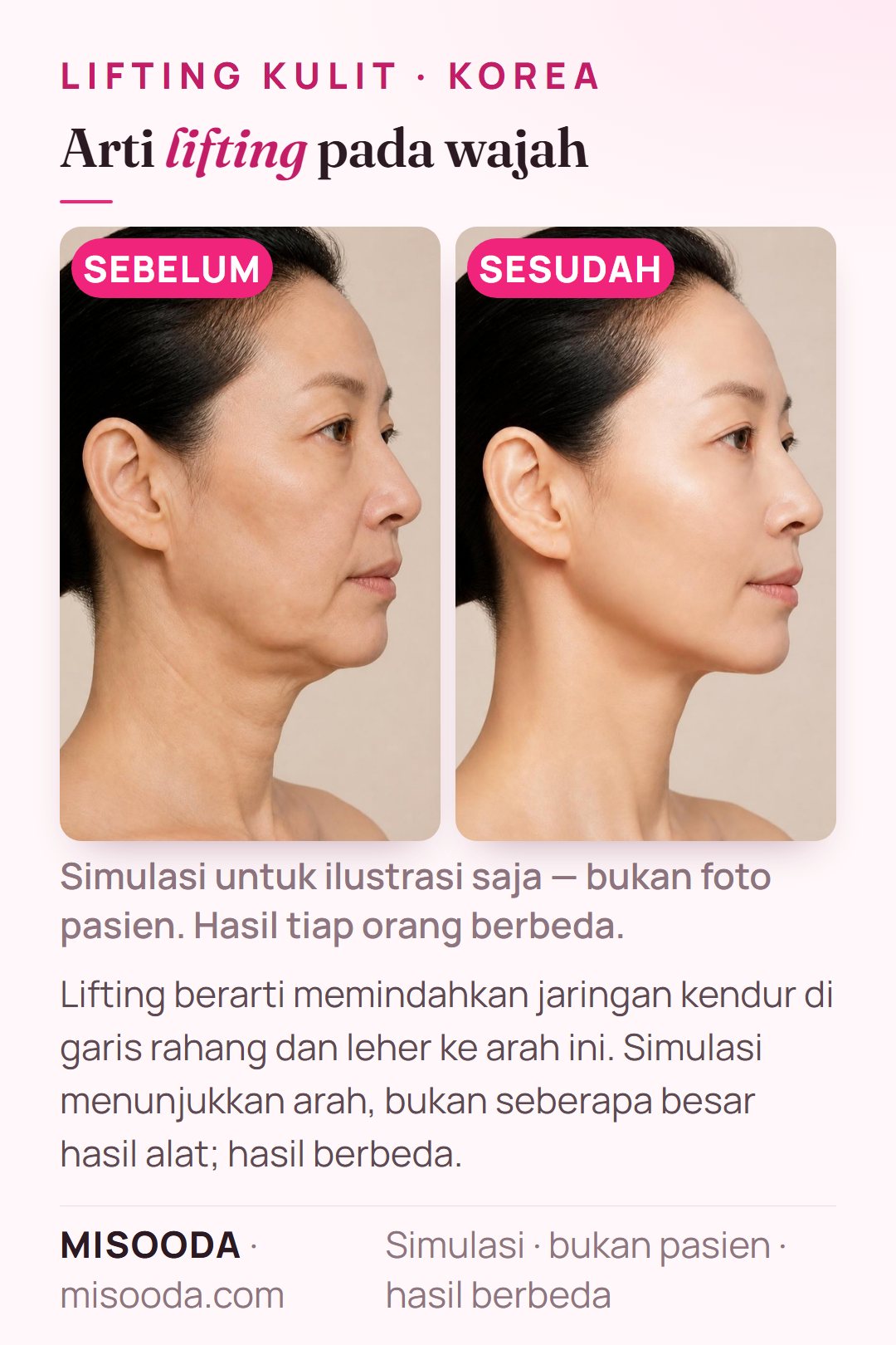 Ilustrasi tujuan lifting SMAS di Korea — memindahkan jaringan kendur di garis rahang dan leher — disimulasikan pada model, bukan pasien; hanya arah perubahan