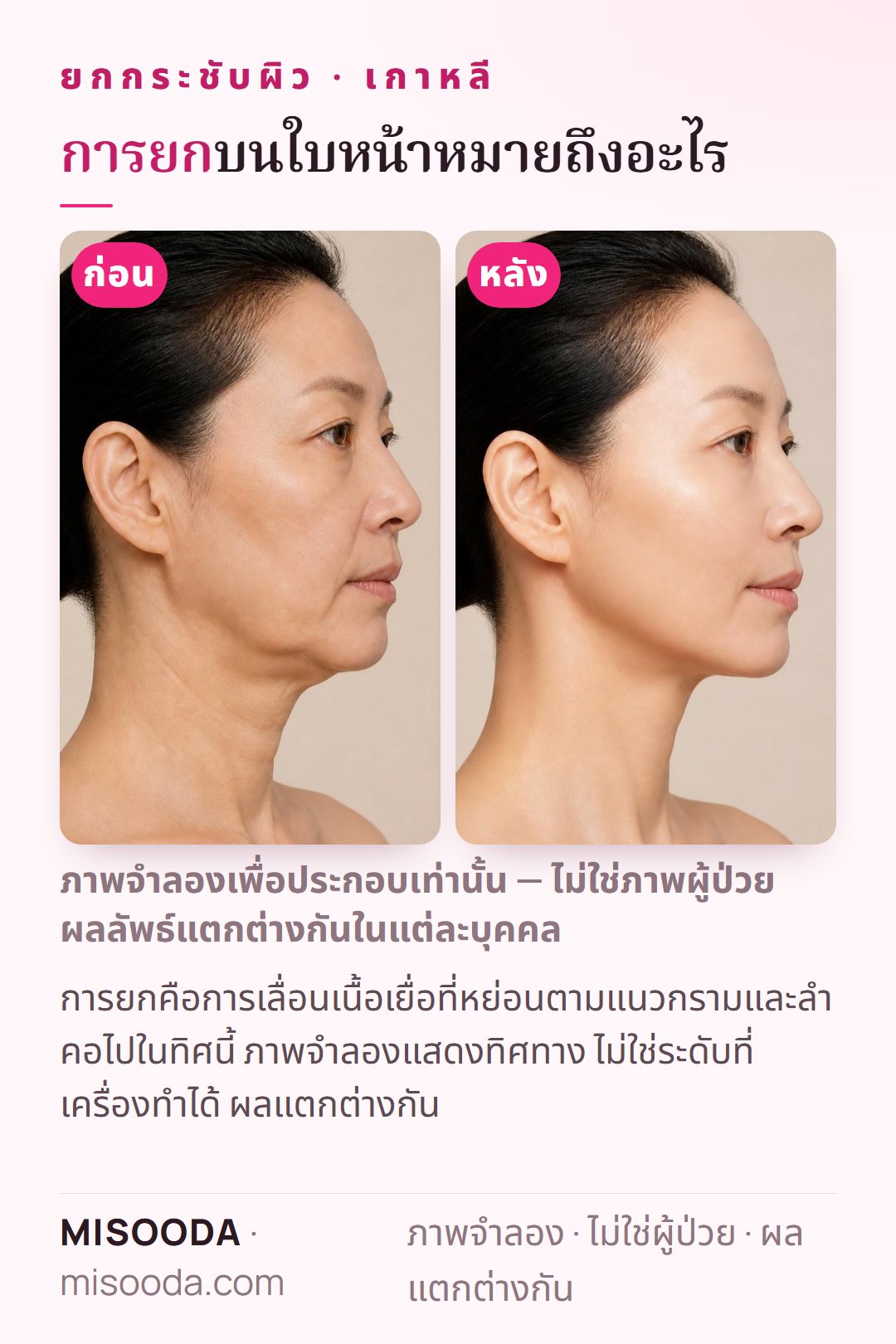 ภาพประกอบเป้าหมายของการยก SMAS ยกกระชับผิว เกาหลี — ปรับตำแหน่งเนื้อเยื่อที่หย่อนตามแนวกรามและลำคอ — จำลองบนนางแบบ ไม่ใช่ผู้ป่วย แสดงเพียงทิศทาง