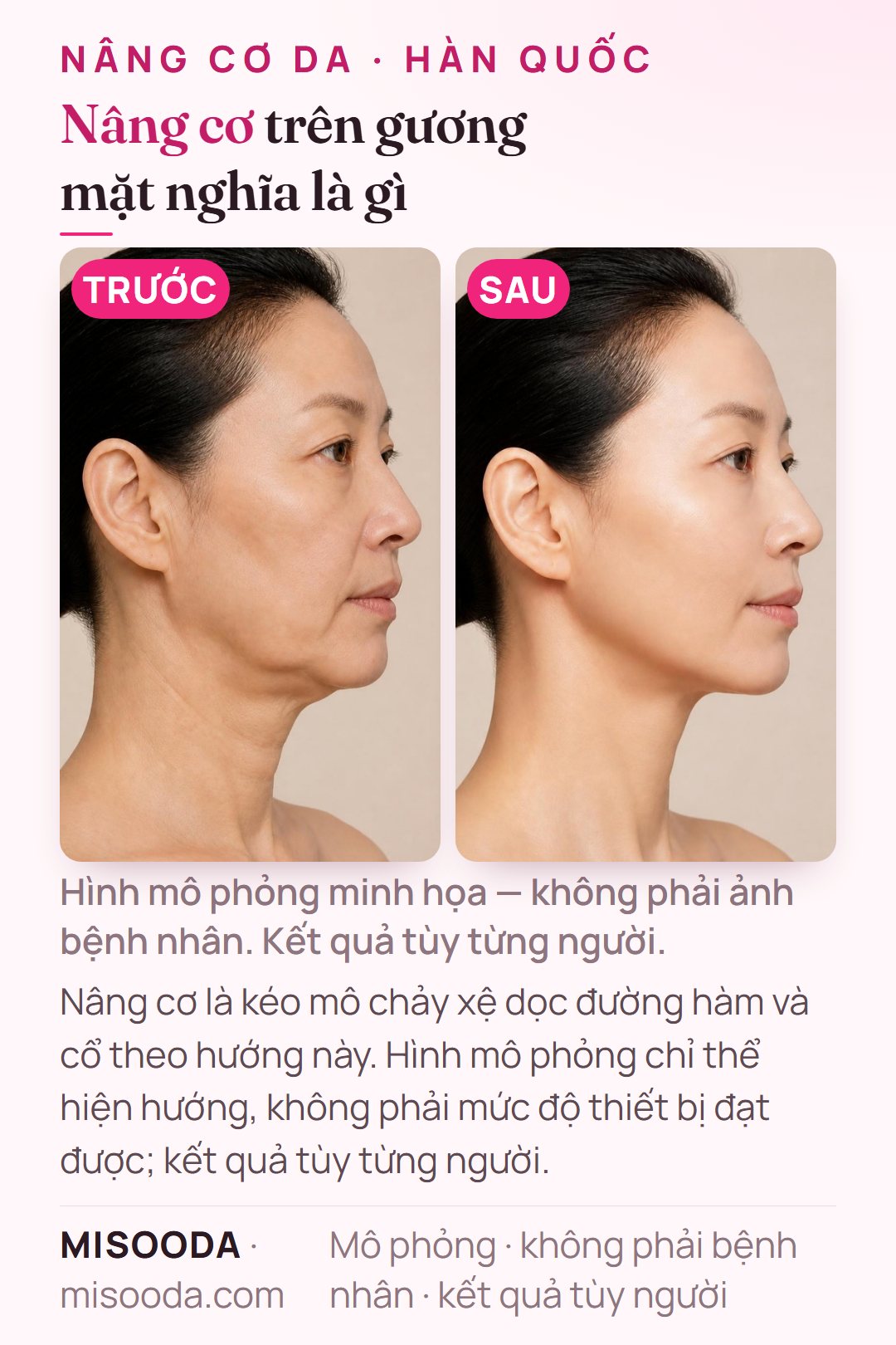 Minh họa mục tiêu của nâng cơ SMAS — nâng mô chảy xệ dọc đường hàm và cổ — mô phỏng trên người mẫu, không phải bệnh nhân; chỉ thể hiện hướng thay đổi