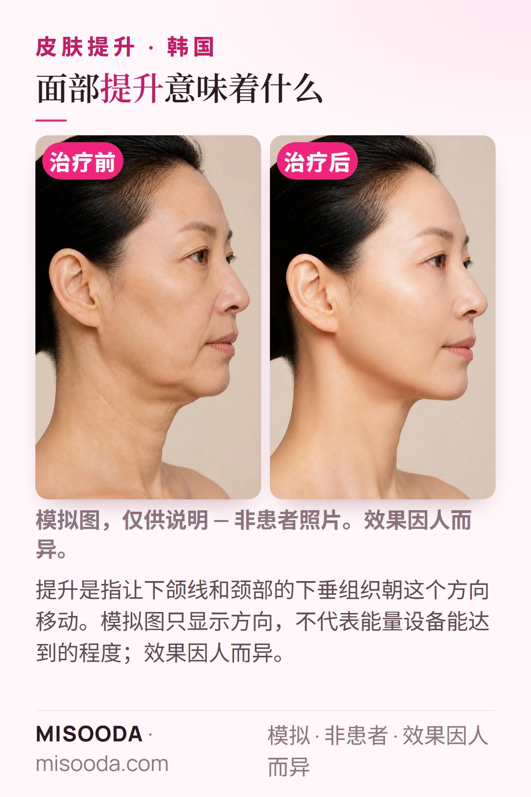 韩国 SMAS 提升目标示意:让下颌线和颈部的下垂组织复位——模特模拟图,并非真实患者,只显示变化方向