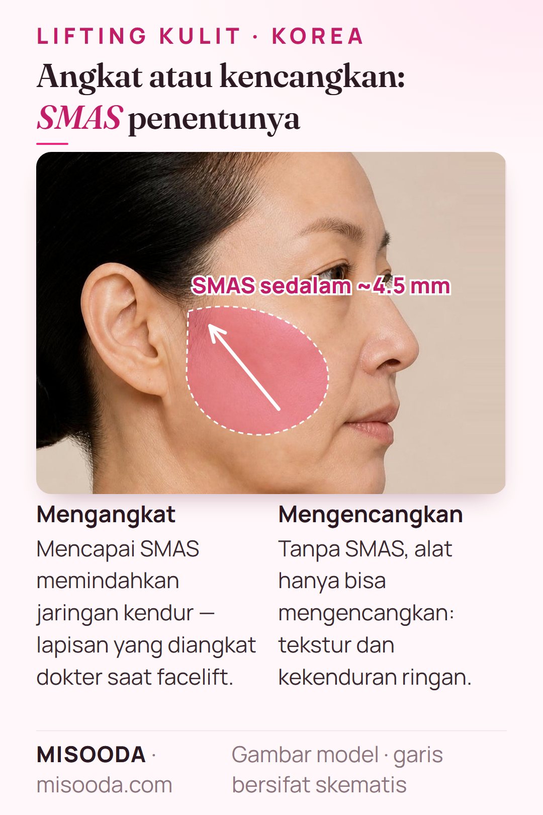 Apa itu SMAS: lapisan berserat sekitar 4.5 mm di bawah kulit yang ditarik saat facelift; alat yang mencapainya bisa mengangkat, yang lain hanya mengencangkan