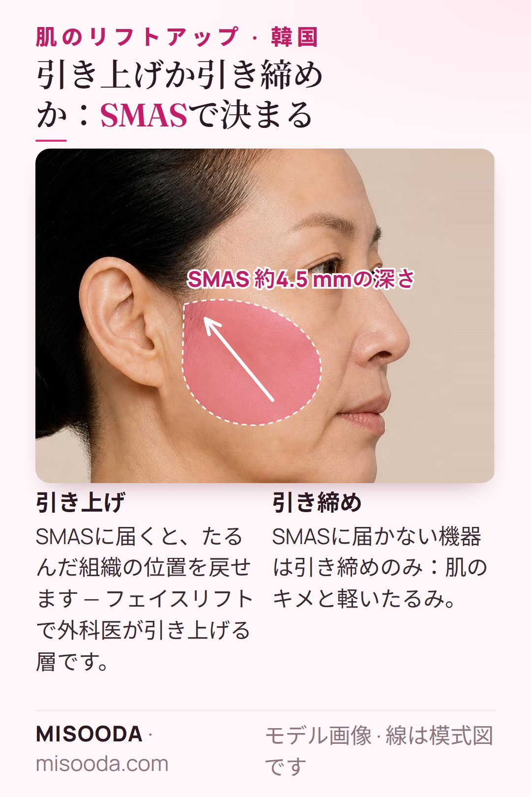 韓国 リフトアップとSMAS:皮膚の約4.5 mm下にあり、フェイスリフトで引き上げる線維性の層。届く機器は引き上げ、届かない機器は引き締めのみ