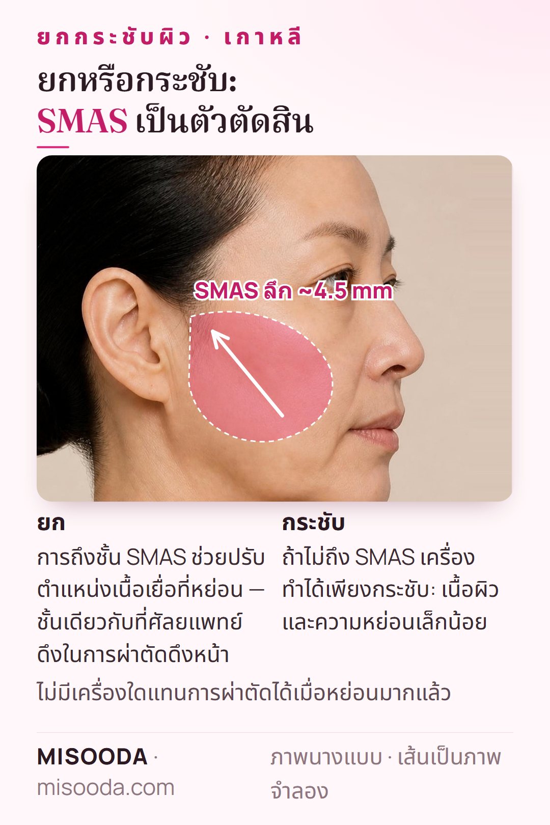 SMAS คืออะไร: ชั้นพังผืดลึกราว 4.5 mm ใต้ผิวที่ดึงในการผ่าตัดดึงหน้า เครื่องที่ถึงชั้นนี้ยกได้ ส่วนเครื่องอื่นทำได้เพียงกระชับ — ยกกระชับผิว เกาหลี