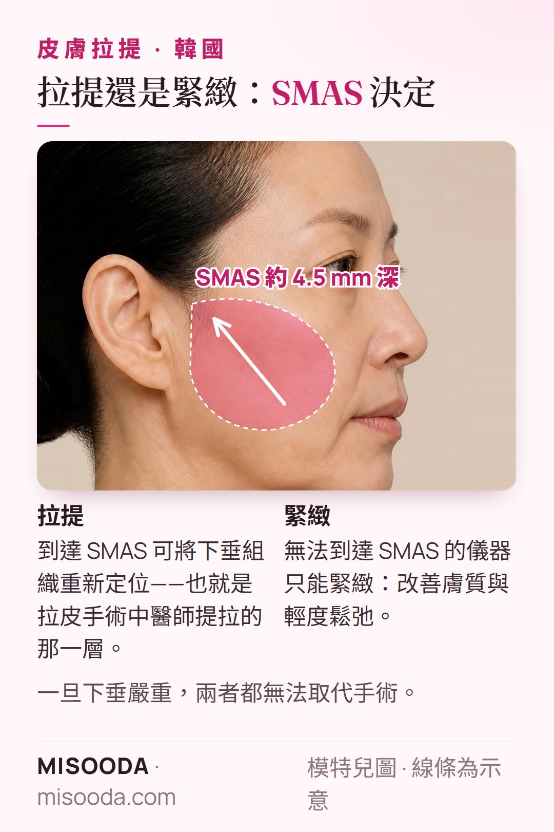 韓國拉提的 SMAS 是什麼:位於皮膚下約 4.5 mm 的纖維層,拉皮手術提拉的就是這一層;能到達的儀器可拉提,其他只能緊緻