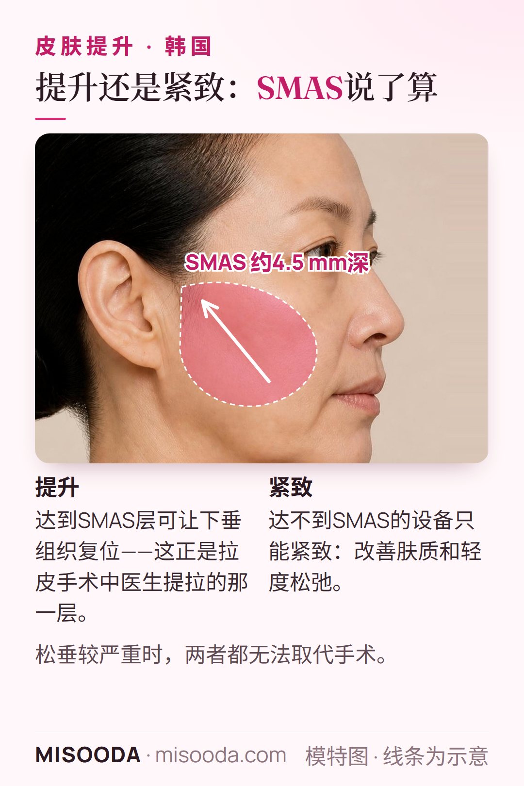 什么是SMAS:皮肤下约4.5 mm的纤维层,拉皮手术提拉的正是这一层;能达到它的设备可以提升,其他只能紧致