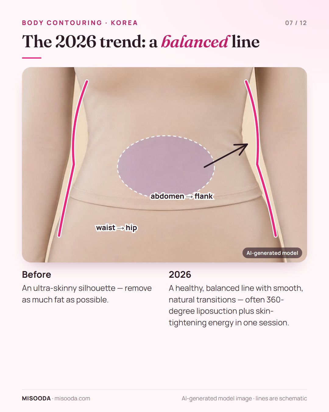 2026 body contouring trend in Korea: smooth waist-to-hip and abdomen-to-flank transitions with 360-degree liposuction instead of an ultra-skinny silhouette