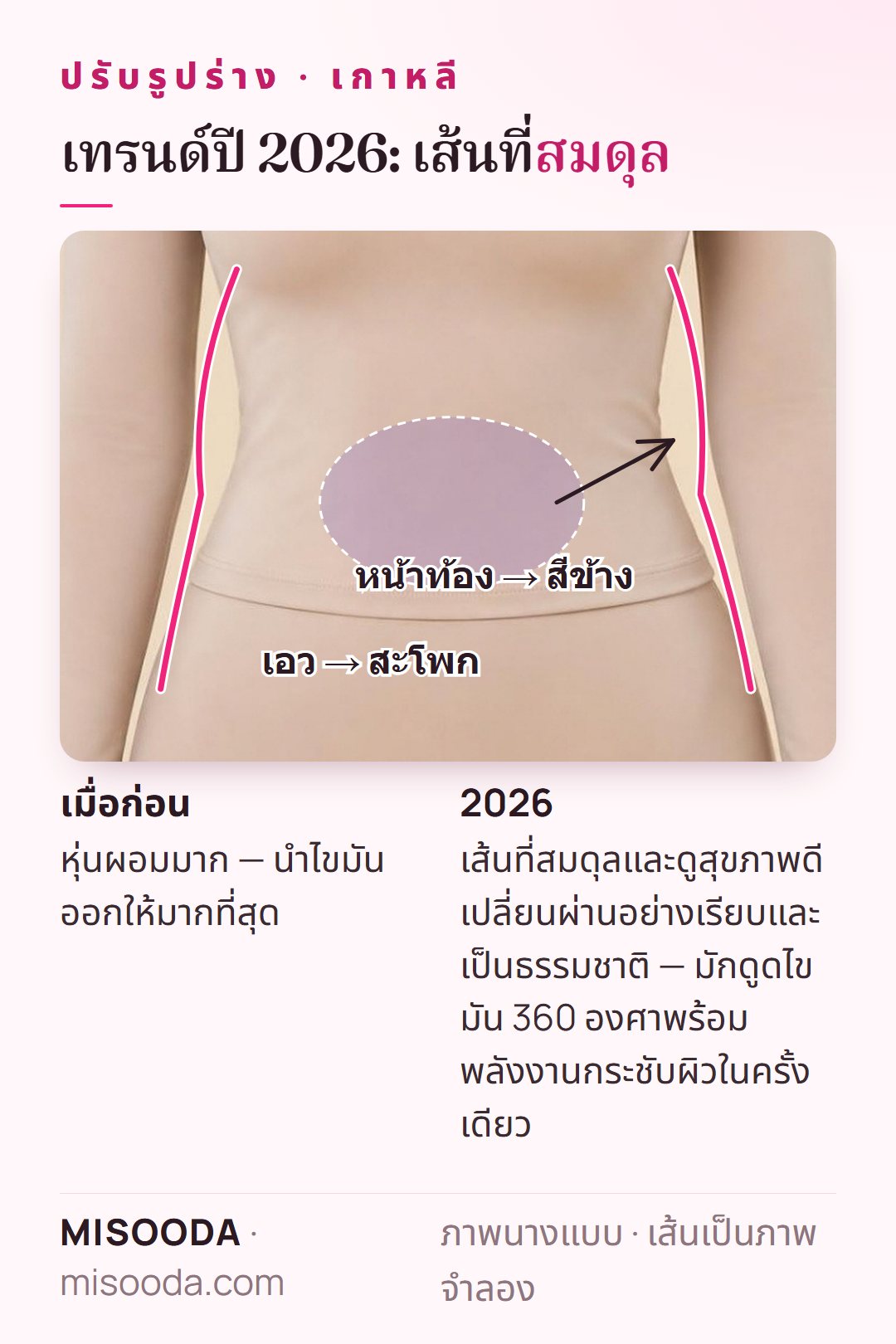 เทรนด์ปรับรูปร่าง เกาหลี ปี 2026: การเปลี่ยนผ่านจากเอวถึงสะโพกและหน้าท้องถึงสีข้างอย่างเรียบด้วยดูดไขมัน 360 องศา แทนหุ่นผอมมาก