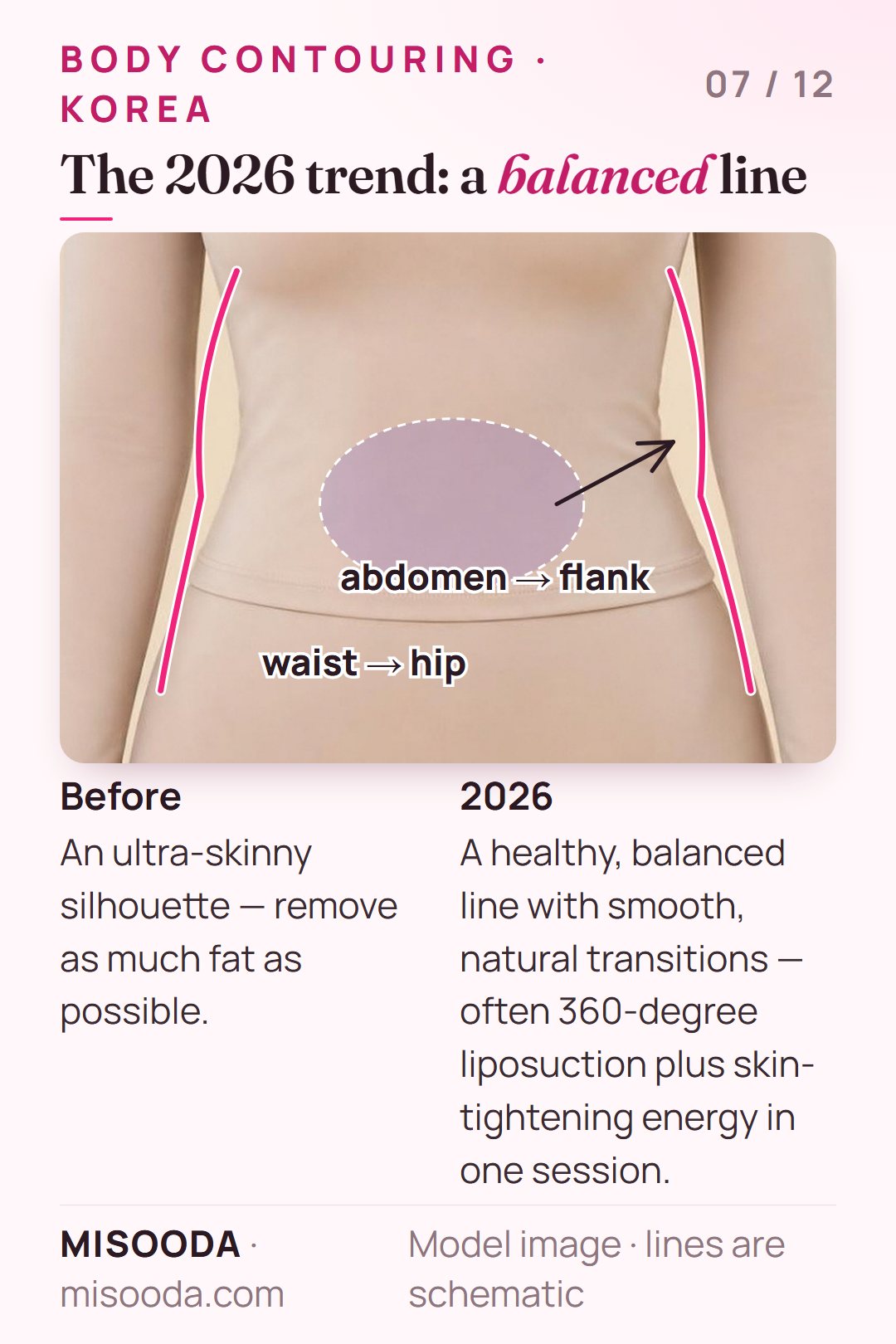 2026 body contouring trend in Korea: smooth waist-to-hip and abdomen-to-flank transitions with 360-degree liposuction instead of an ultra-skinny silhouette