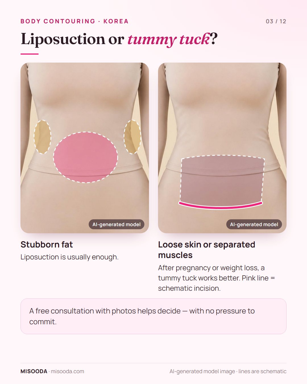 Liposuction vs tummy tuck for body contouring: liposuction for stubborn fat, tummy tuck for loose skin or separated muscles after pregnancy or weight loss