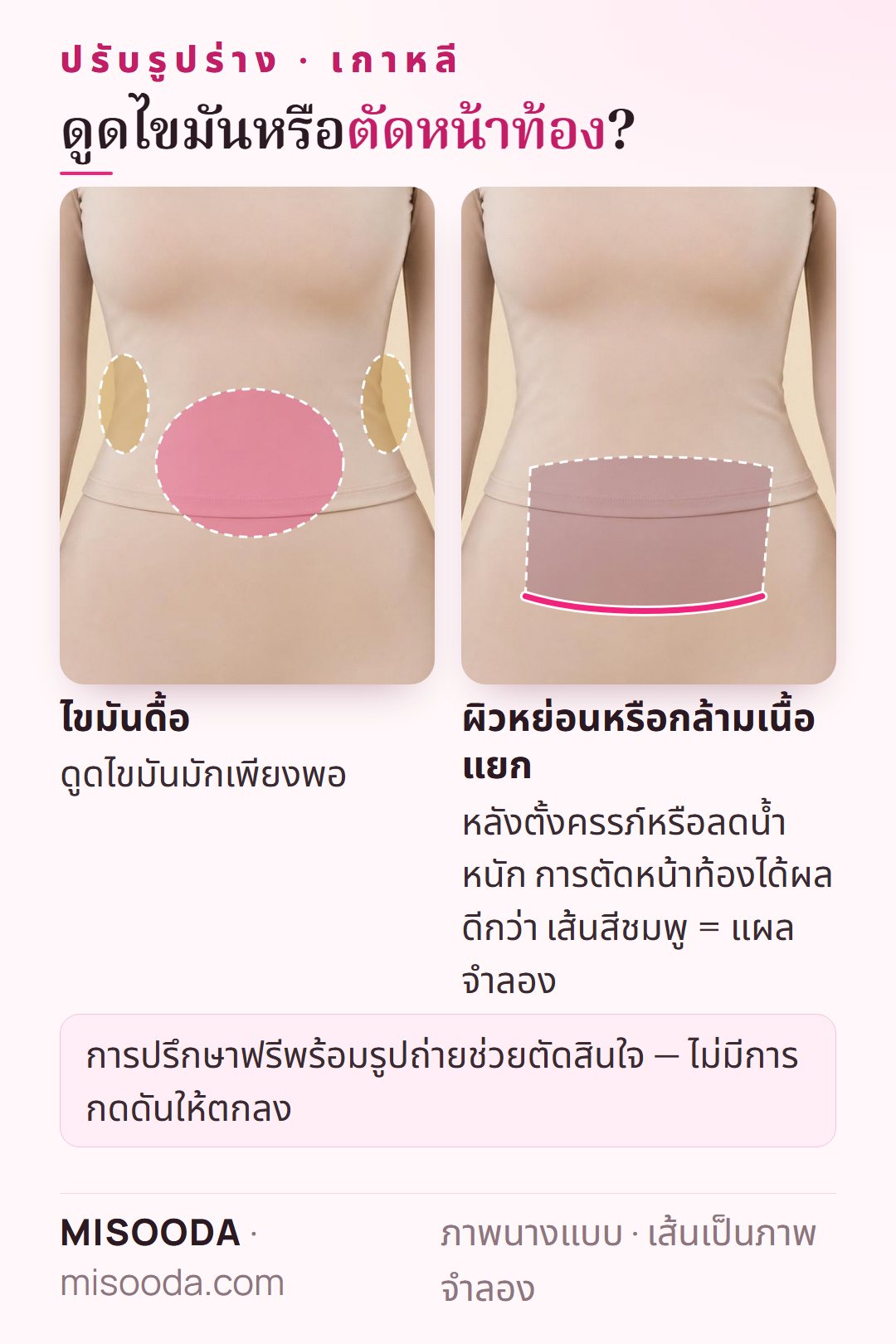 ดูดไขมัน vs ตัดหน้าท้อง สำหรับปรับรูปร่าง เกาหลี: ดูดไขมันสำหรับไขมันดื้อ ตัดหน้าท้องสำหรับผิวหย่อนหรือกล้ามเนื้อแยกหลังตั้งครรภ์หรือลดน้ำหนัก