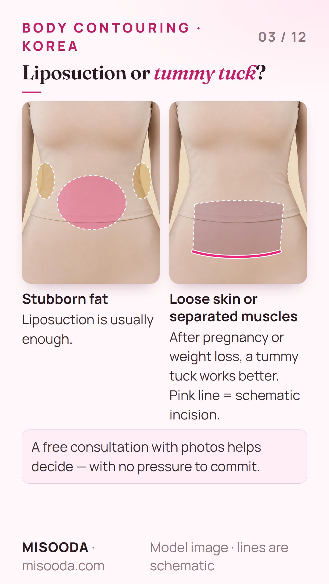 Liposuction vs tummy tuck for body contouring: liposuction for stubborn fat, tummy tuck for loose skin or separated muscles after pregnancy or weight loss