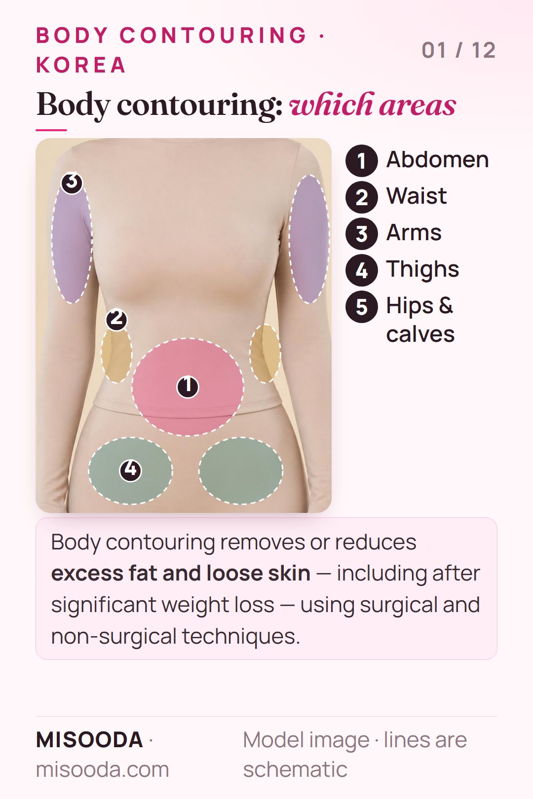 Body contouring treatment areas in Korea on a body: abdomen, waist and flanks, upper arms, thighs, plus hips and calves