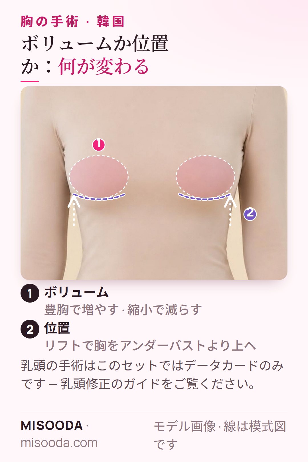服を着たモデルで模式的に示す豊胸・縮小・リフト:胸のボリュームの範囲と、胸をアンダーバストより上へ上げるリフト — 韓国 胸の手術