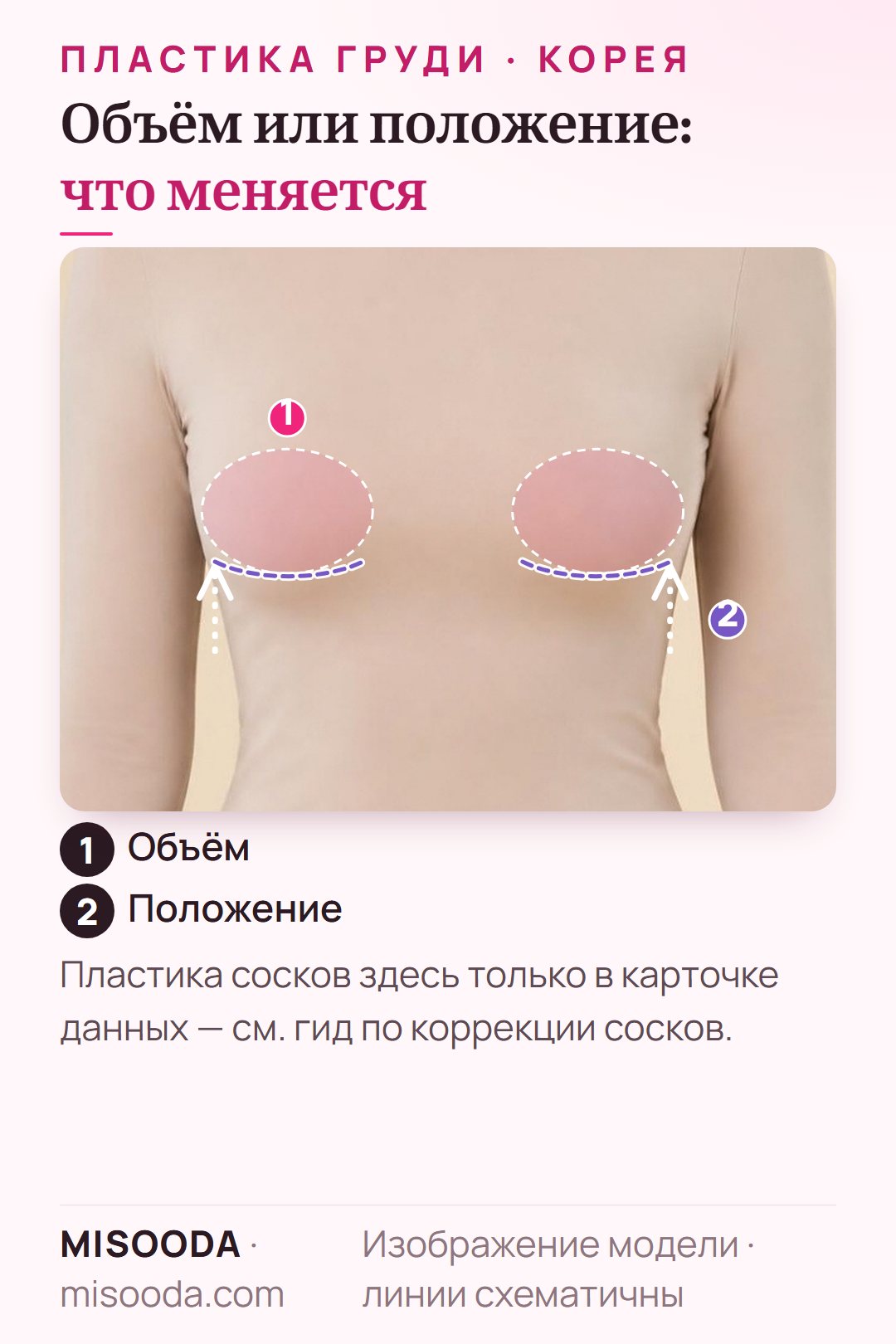 Увеличение, уменьшение и подтяжка груди схематично на одетой модели: зоны объёма груди и подтяжка, поднимающая грудь над складкой