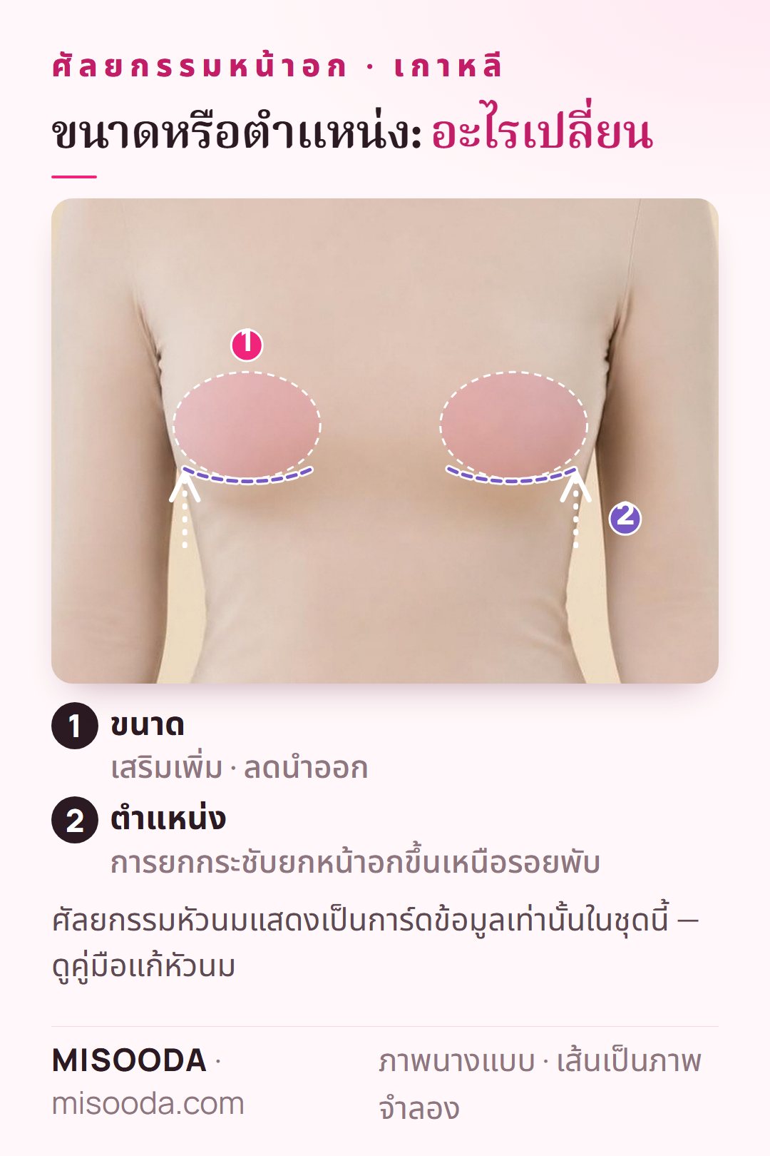 เสริม ลดขนาด และยกกระชับหน้าอก เกาหลี แสดงแบบจำลองบนนางแบบที่สวมเสื้อผ้า: บริเวณขนาดหน้าอกและการยกหน้าอกขึ้นเหนือรอยพับ